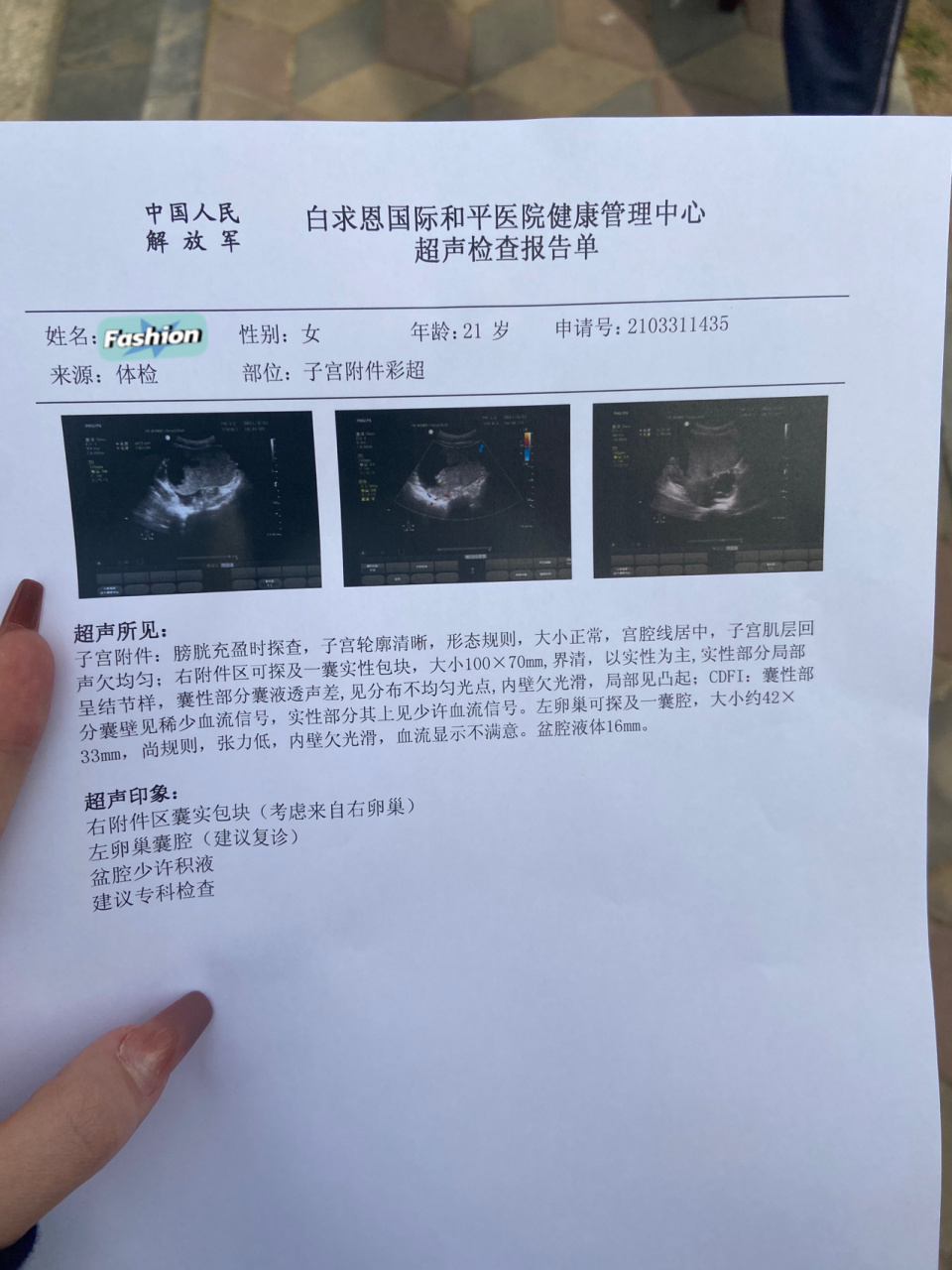 10cmx 7cm卵巢囊肿开腹 3月底 肚子不舒服然后去医院体检 检查出体积
