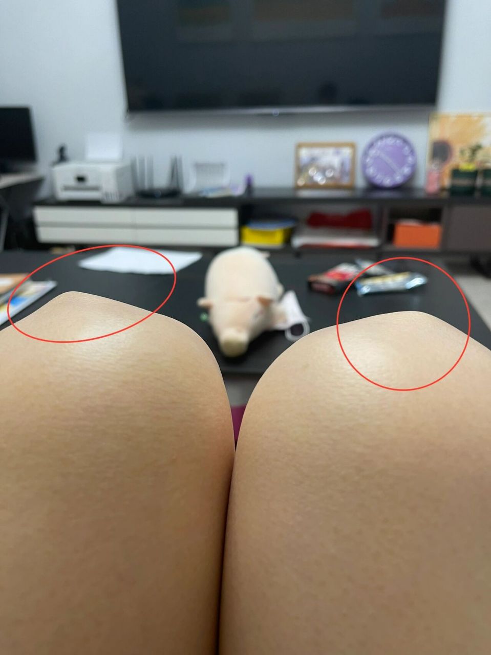 左右腿膝盖外侧骨头凸起,这是怎么回事