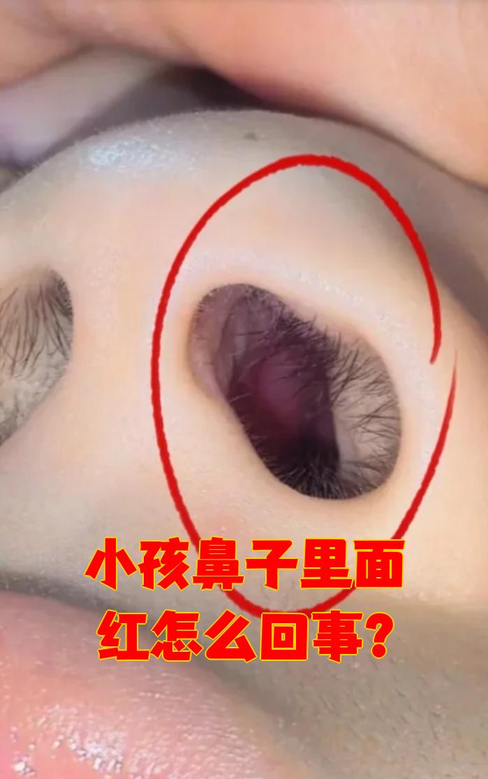 反复挖鼻孔:孩子总用手抠鼻子容易让鼻腔内毛细血管充血肿胀,导致鼻