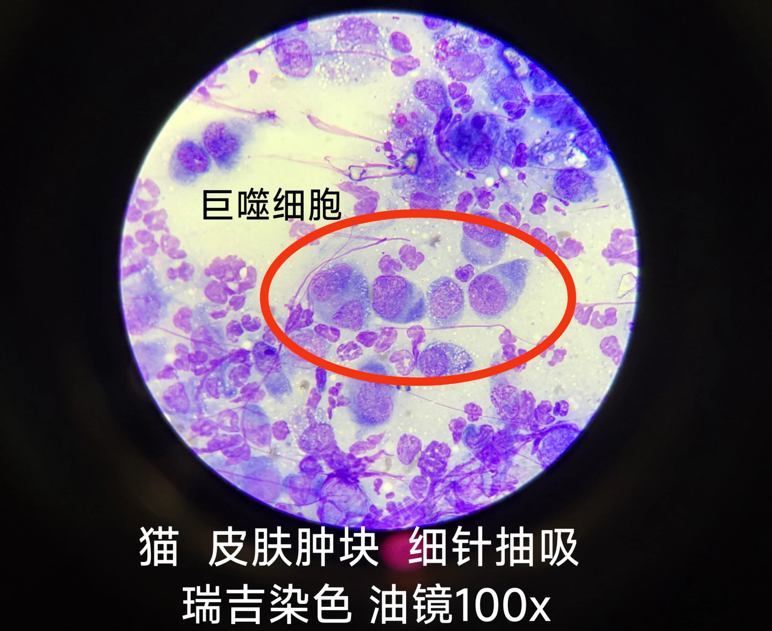 肉芽肿性炎症意义: > 细胞学表现 - 嗜中性粒细胞 巨噬细胞(>50%)