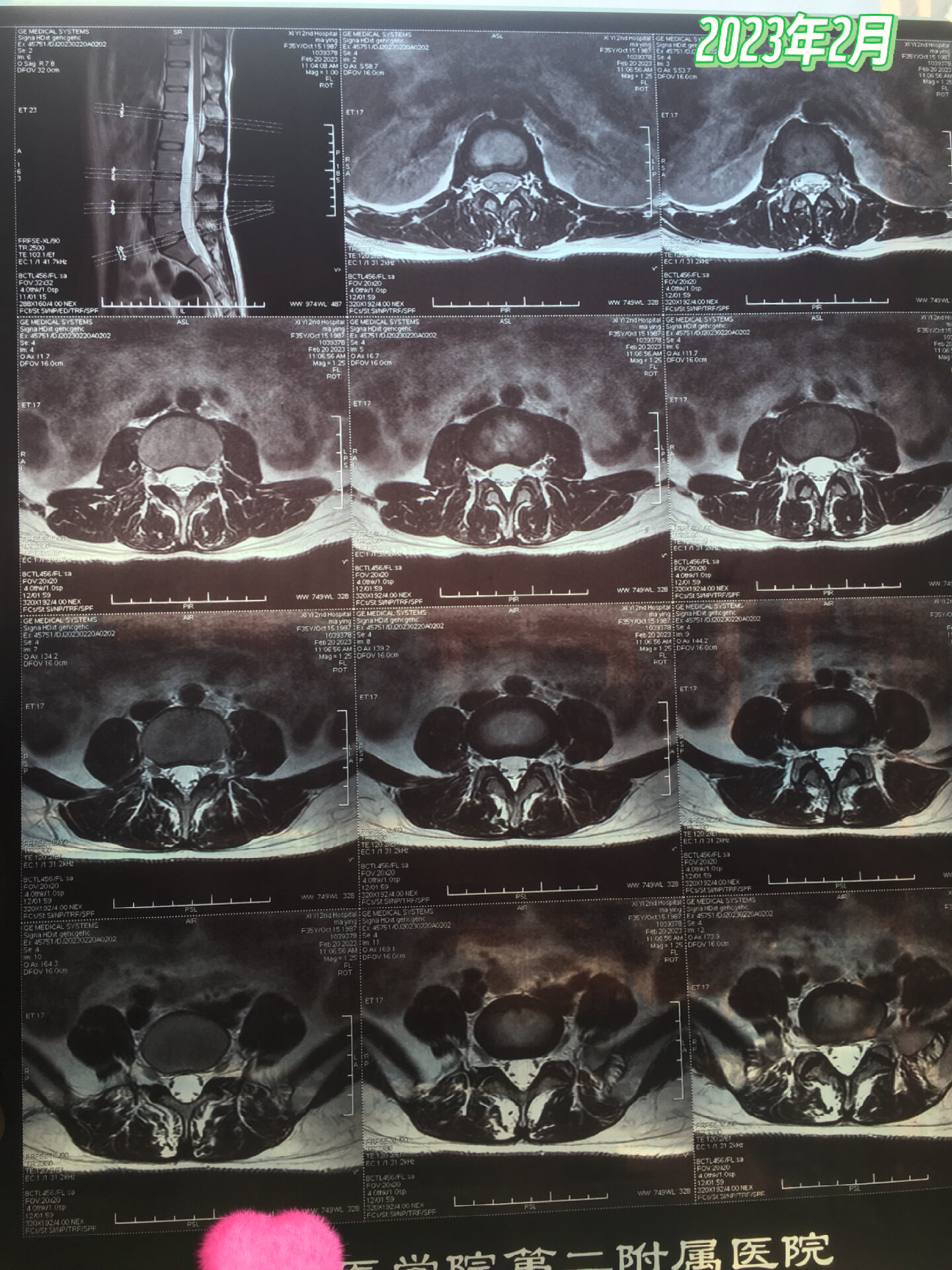 是否腰突,磁共振片子如何解读?