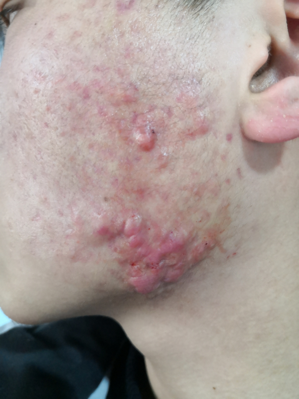 痤疮后的疤痕.下颌角部位的瘢痕疙瘩.#疤痕修复##瘢痕疙瘩