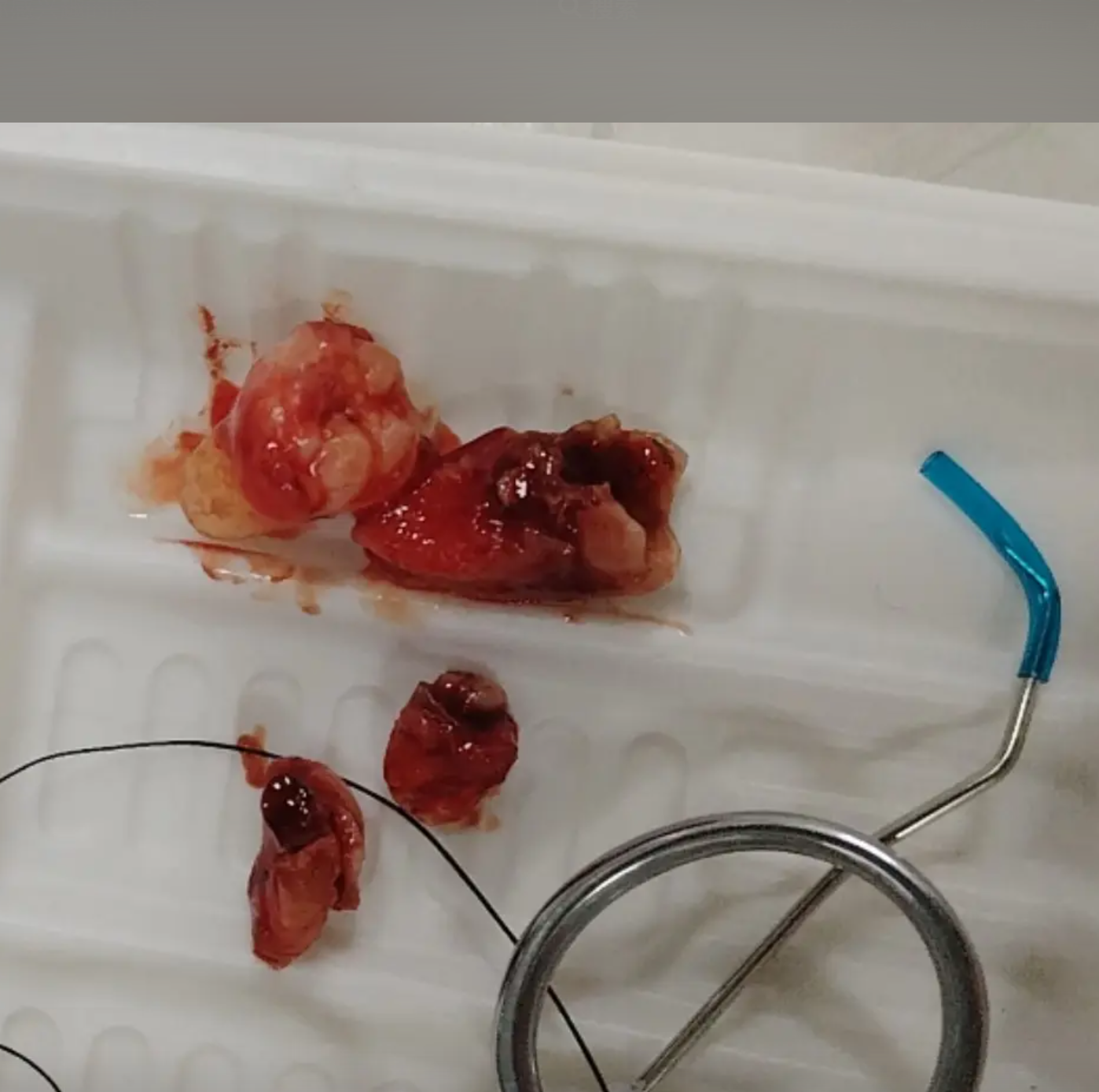 没长出来的智齿如果发炎或者顶到其他牙齿,这种情况叫阻生智齿,需要