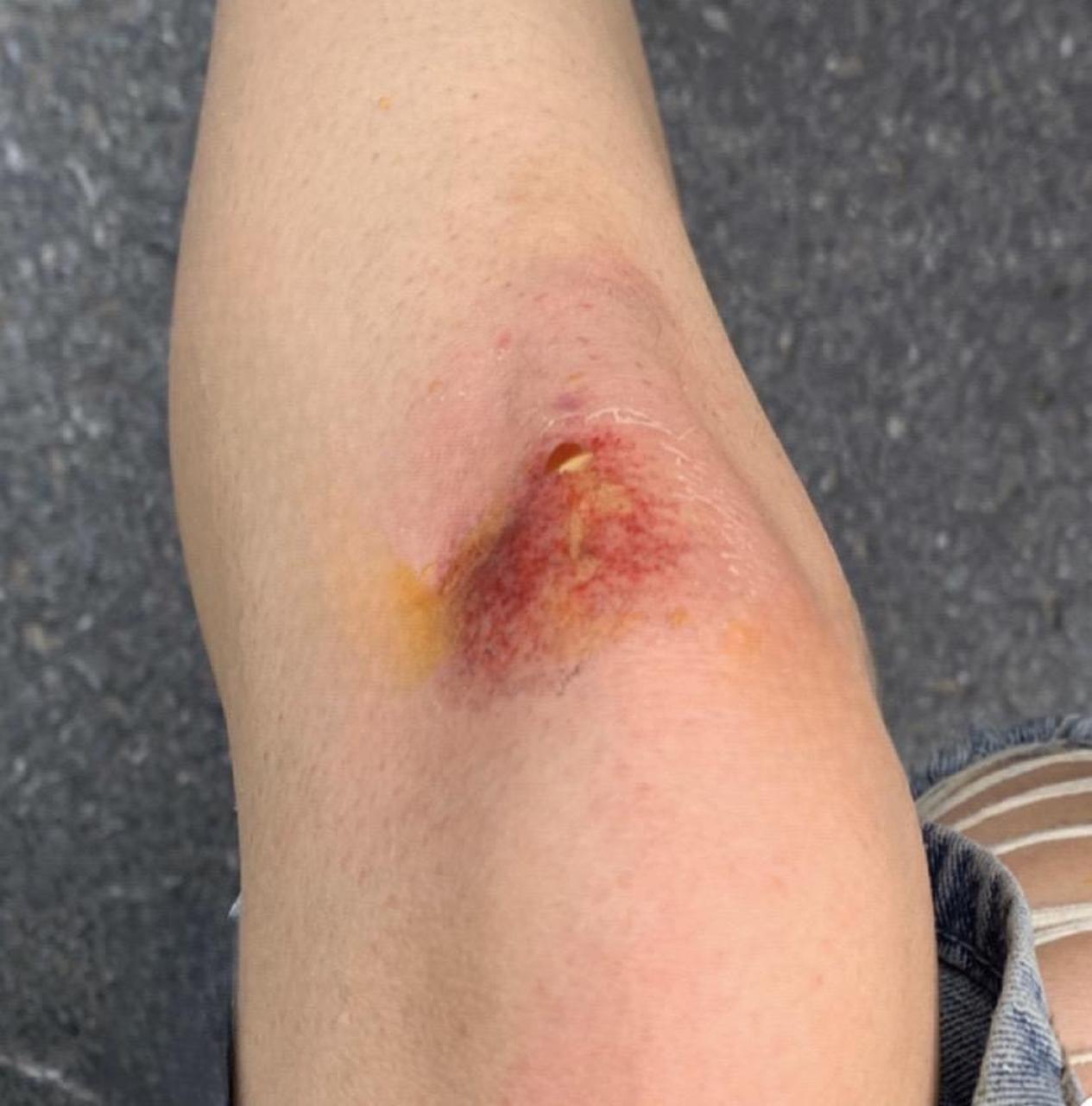 下班骑车回来摔了一跤,很疼车胎也爆了,换一下100