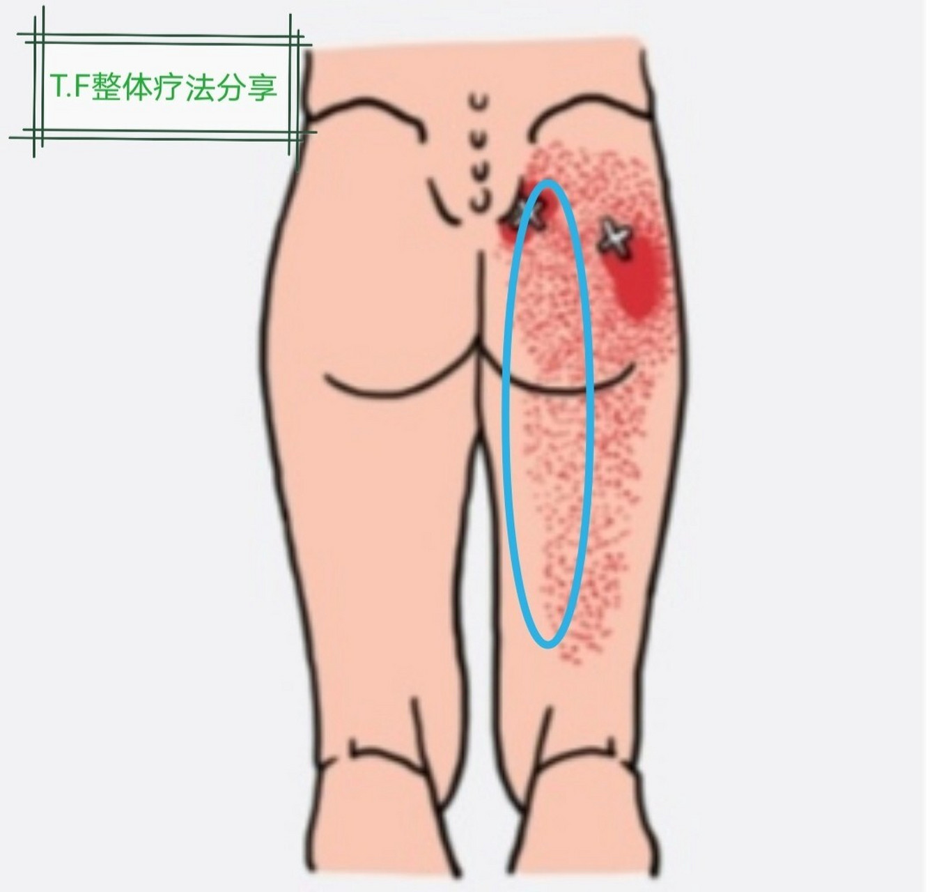 腿部疝气的症状图片图片