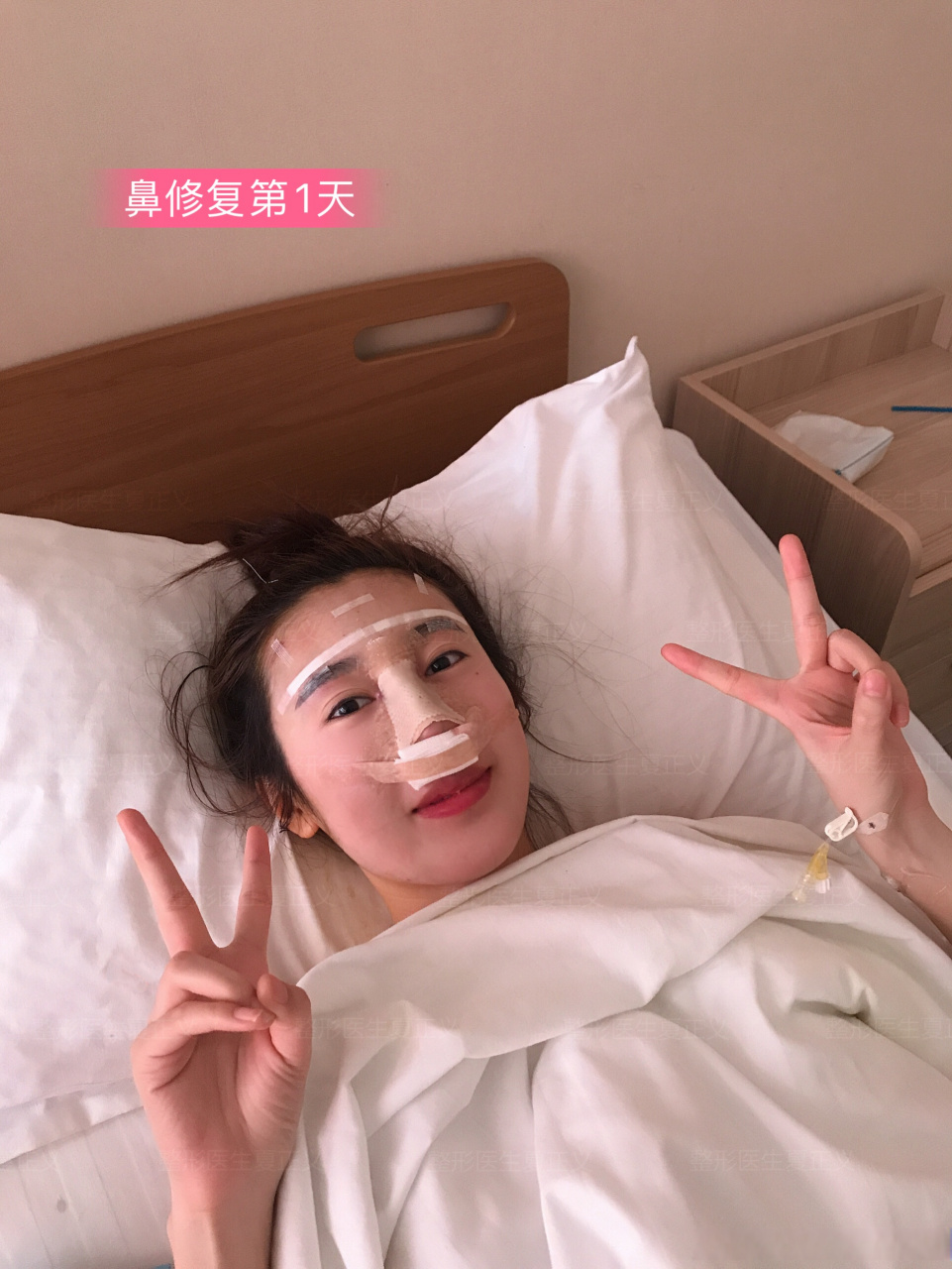 通天鼻修复9天恢复过程记录; 术前情况:患者术前做的硅胶 耳软骨隆鼻