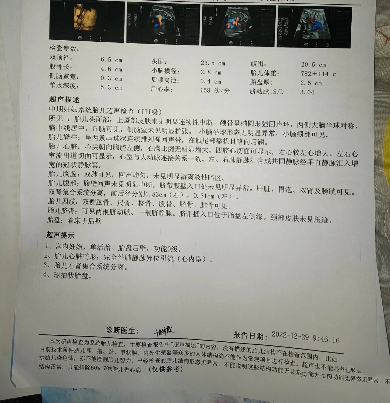 肺静脉异位引流