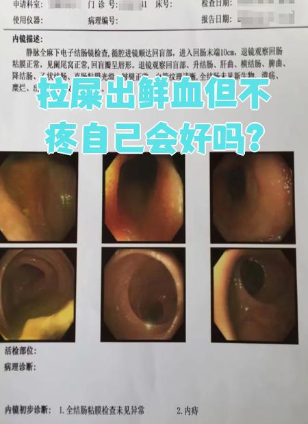 内痔出血一般是鲜红色的血,可能粘在大便表面或便后滴血