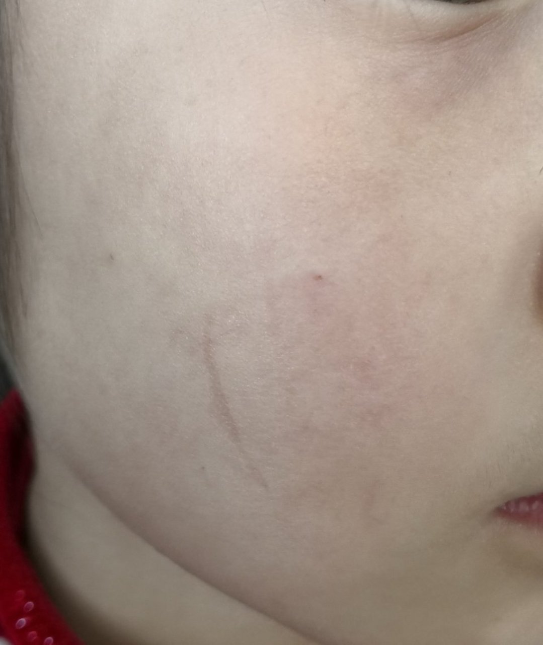 儿童面部划伤痕迹#疤痕##疤痕修复