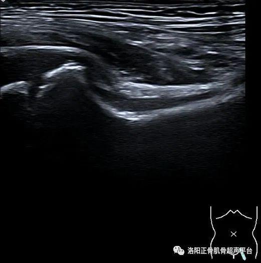 病例分享小儿髋关节滑膜嵌顿症