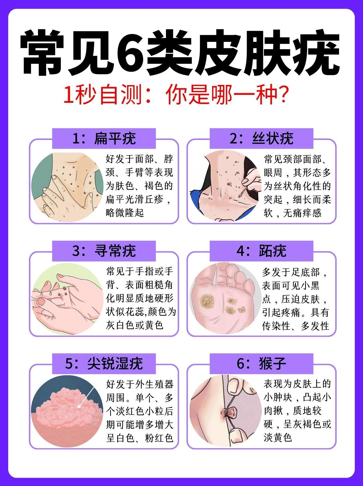 别说你还不知道:皮肤长小肉揪扁平疣的快进