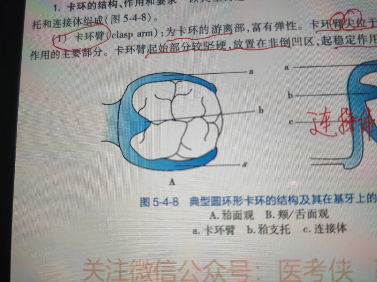 学习打卡第7天🔥🔥 三臂卡环:外形好,固位力稳