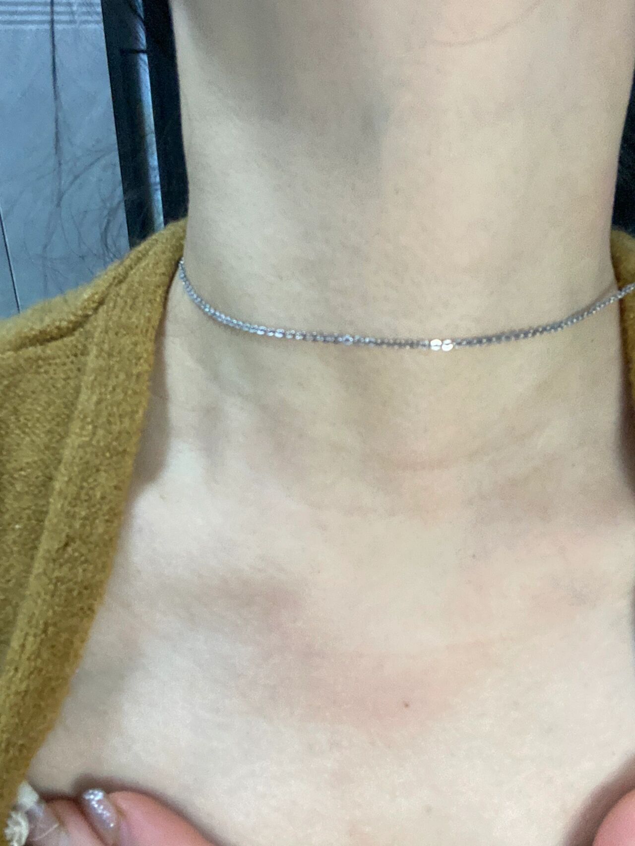 系统性红斑狼疮 狼友们脖子上红了一大片特别痒是什么东西呢