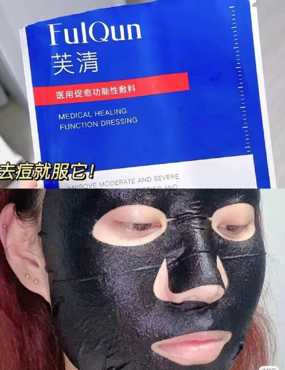 都说痘痘肌最好不要敷面膜,  芙清可是专门为痘痘肌而生的产品呀!