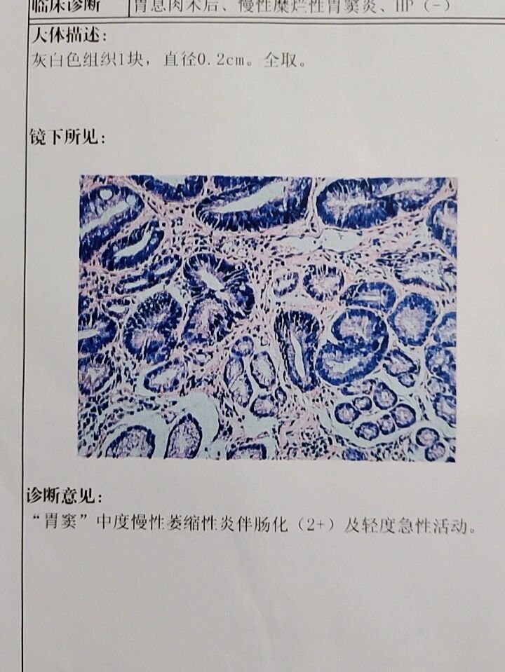 胃窦中度慢性萎缩性伴肠化 我爆吃爆饮的报应