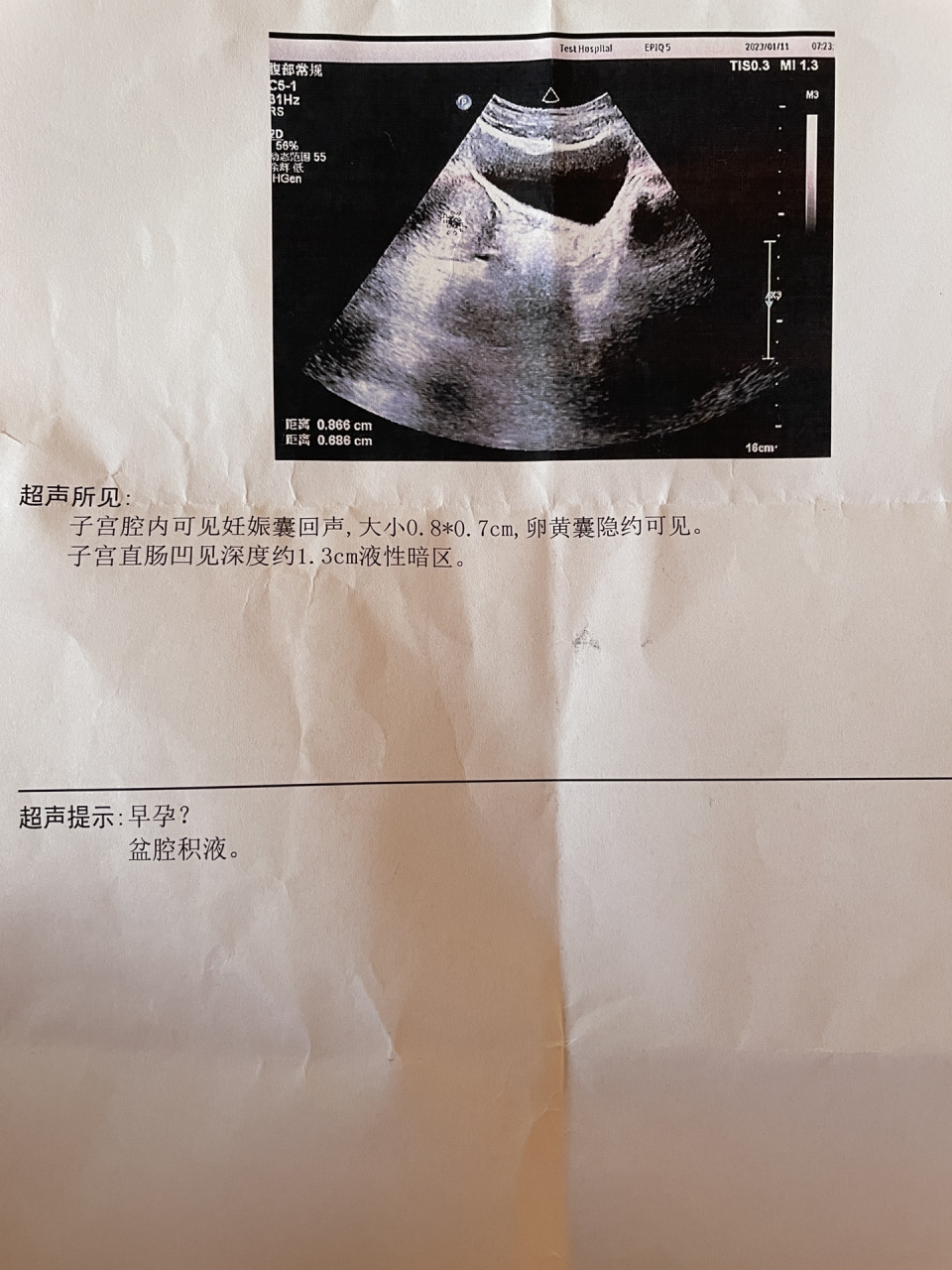 孕囊彩超图片图片