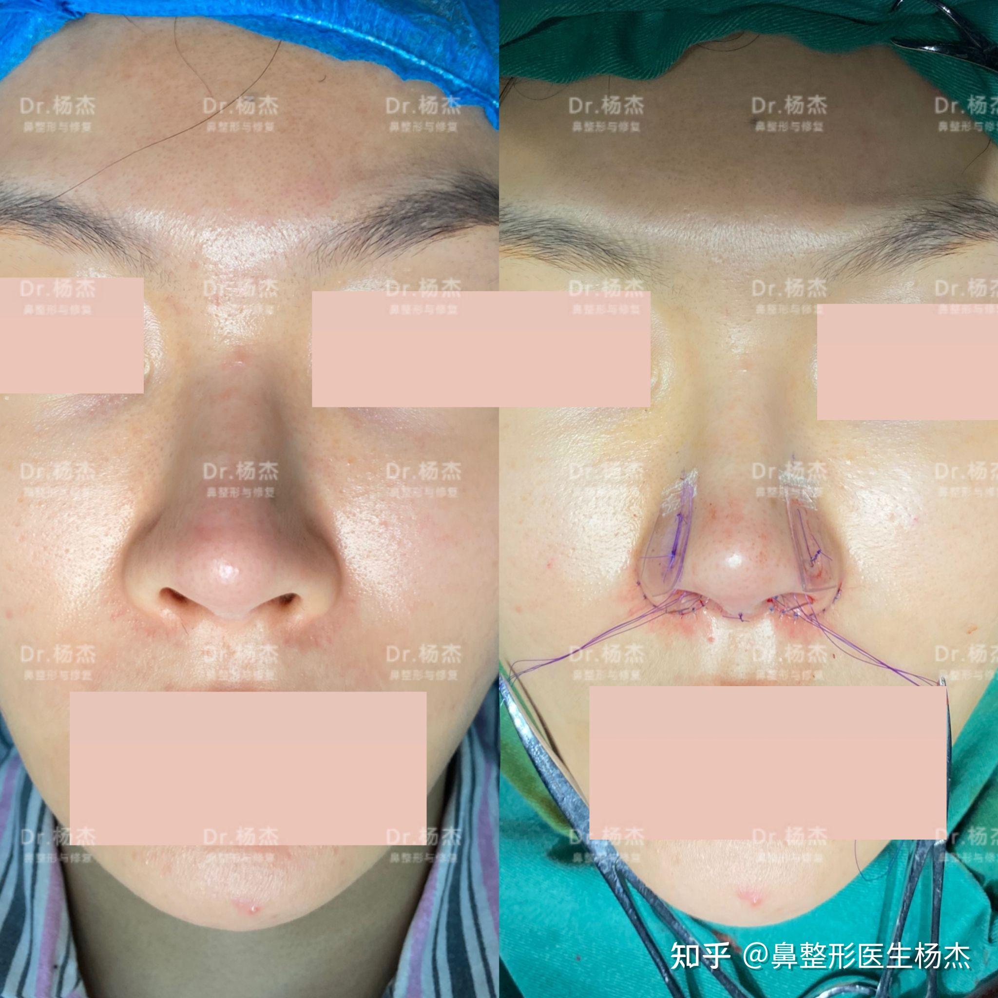鼻翼内切缩小鼻槛上提鼻翼缘退缩矫正鼻小柱延长