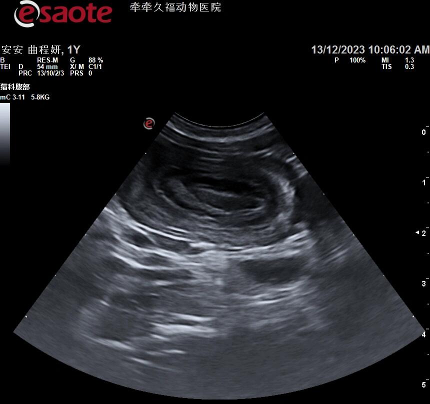 肠套叠超声影像图