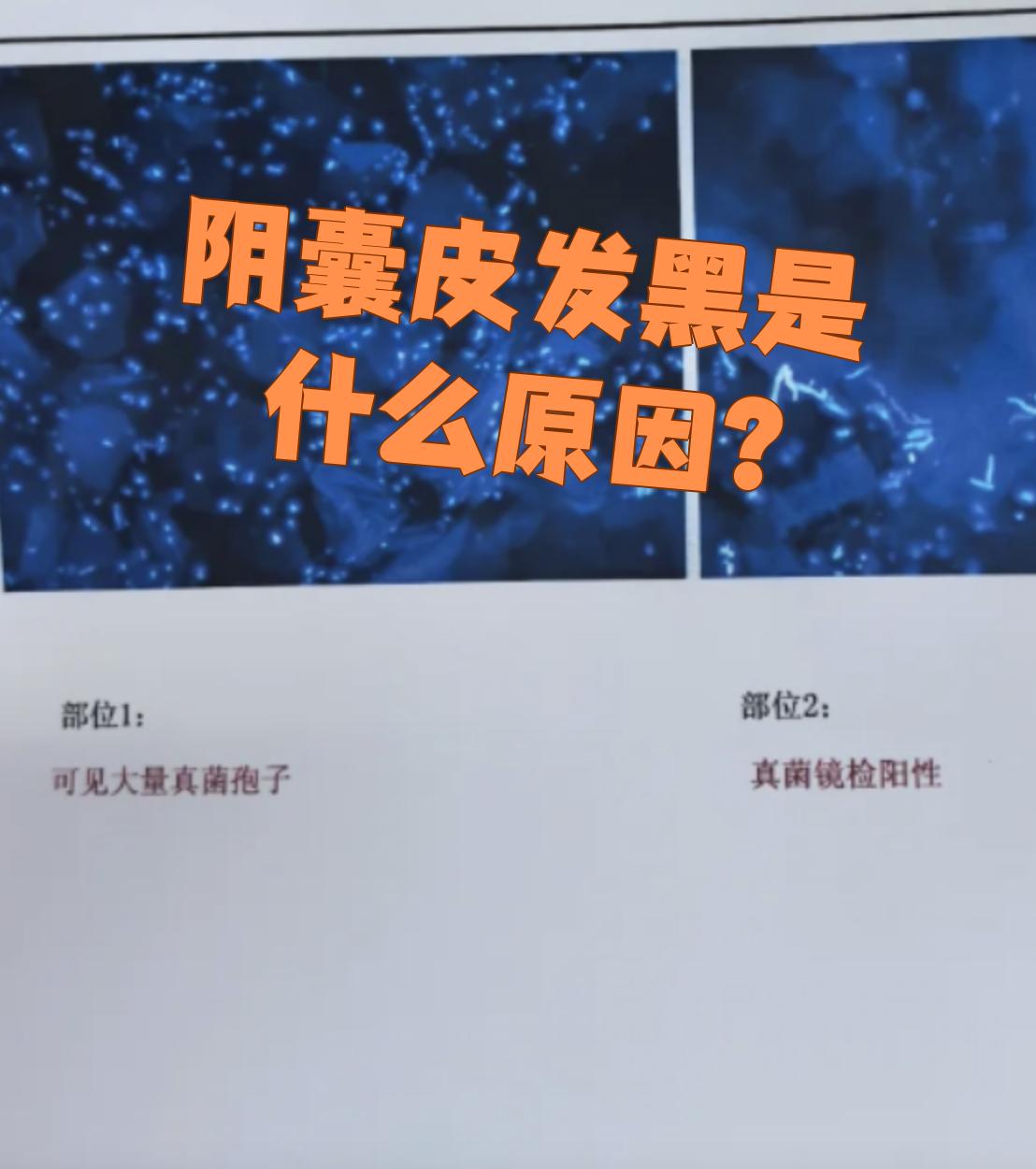 阴囊皮肤发黑可能和遗传,年龄增长或真菌感染有关