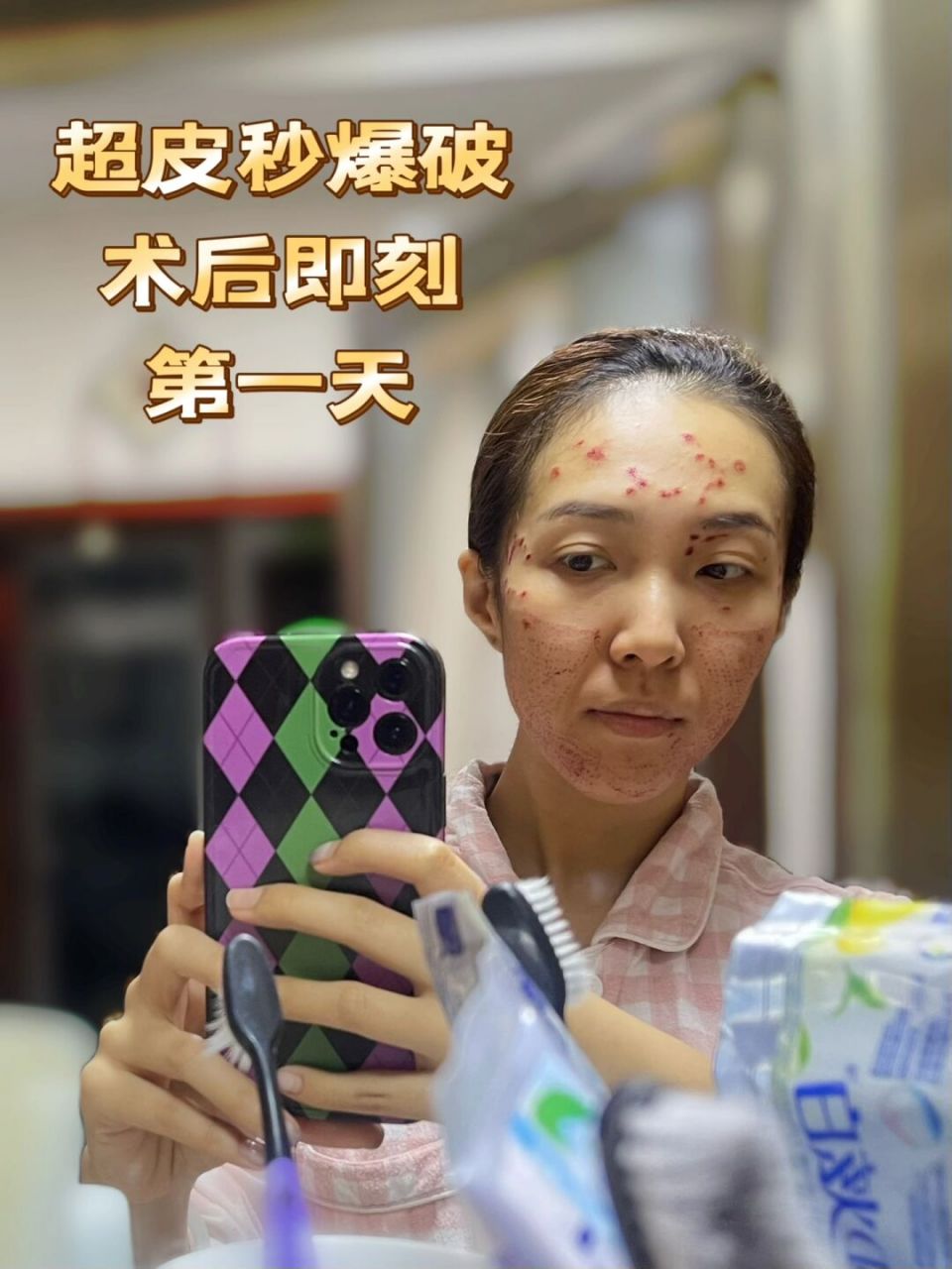 超皮秒爆破术后即刻~(陆续更新) 今天鼓起勇气来做超皮秒爆破模式了