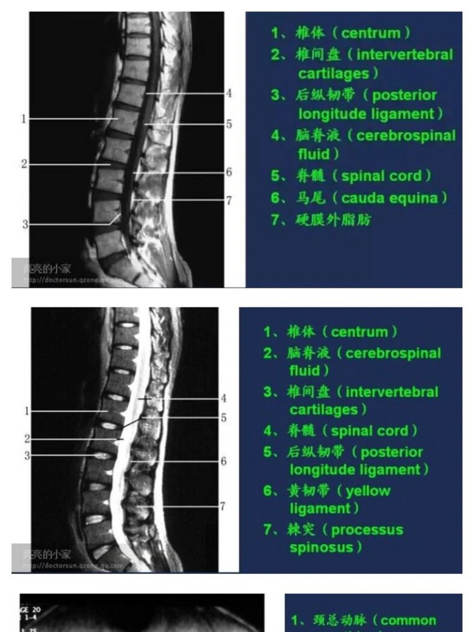 腰椎核磁图解图片