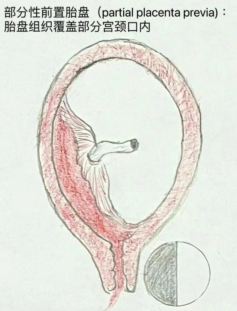 妊娠28周以后,胎盘位置低于胎先露部,附着在子宫下段,下缘达到或父乔