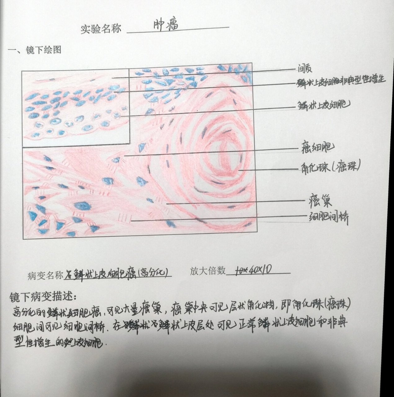 病理绘图 鳞状上皮细胞癌(高分化) 癌巢,角化珠,细胞间桥08