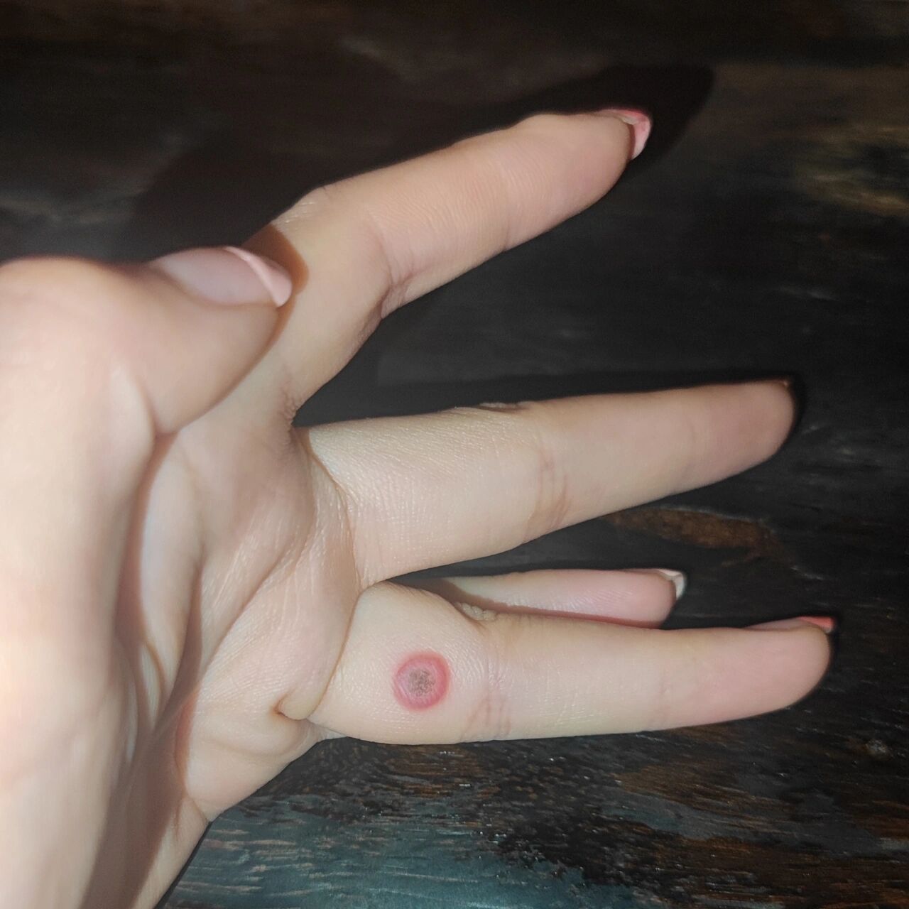 液氮冷冻去寻常疣的第二天