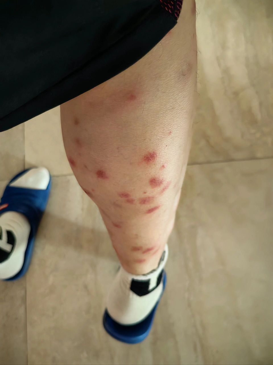 槟榔虫椰梦长廊 椰梦长廊这边的槟榔虫太狠了,最后还是丹皮酚软膏