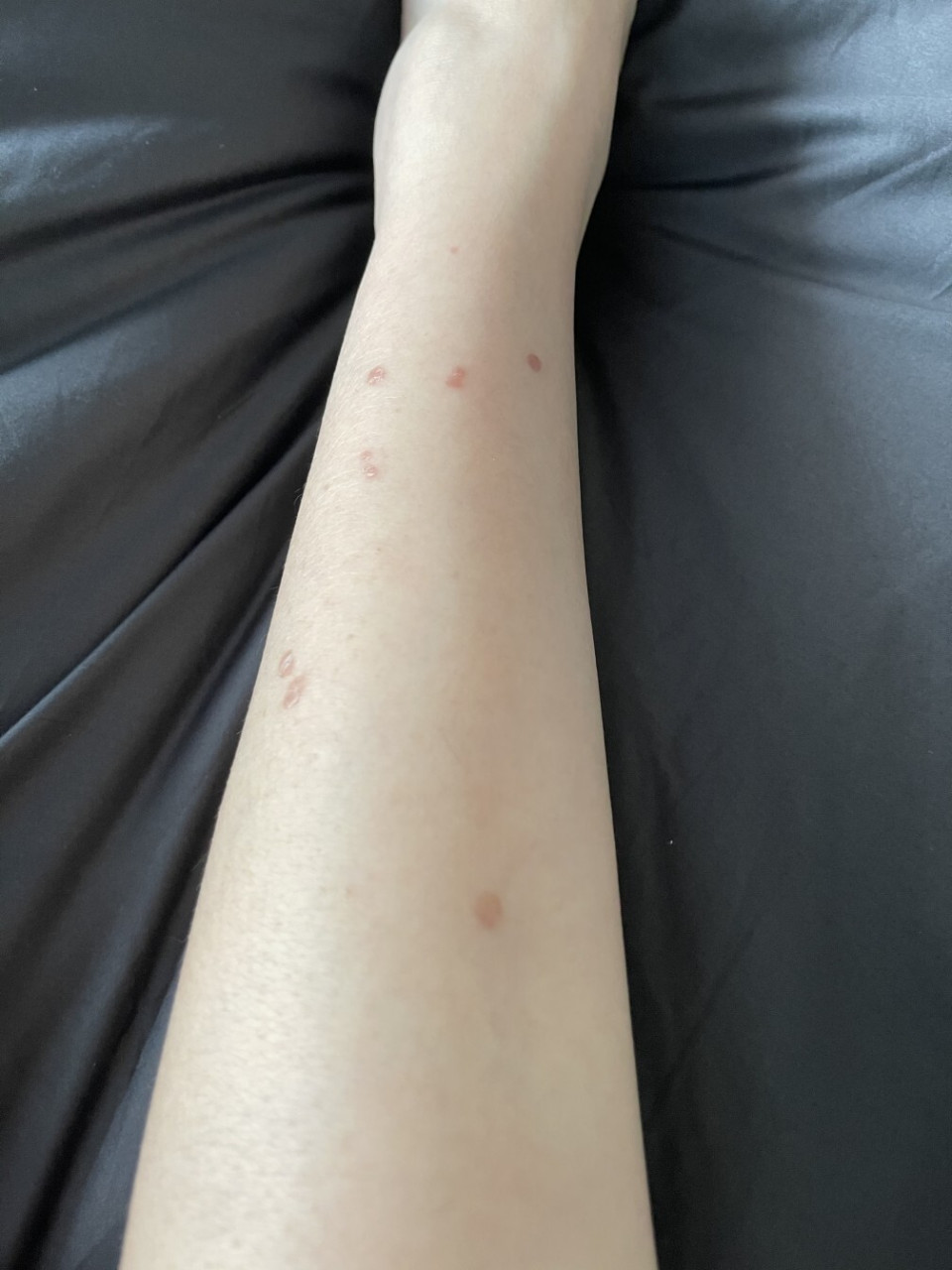 欣赏一下腿上的扁平疣