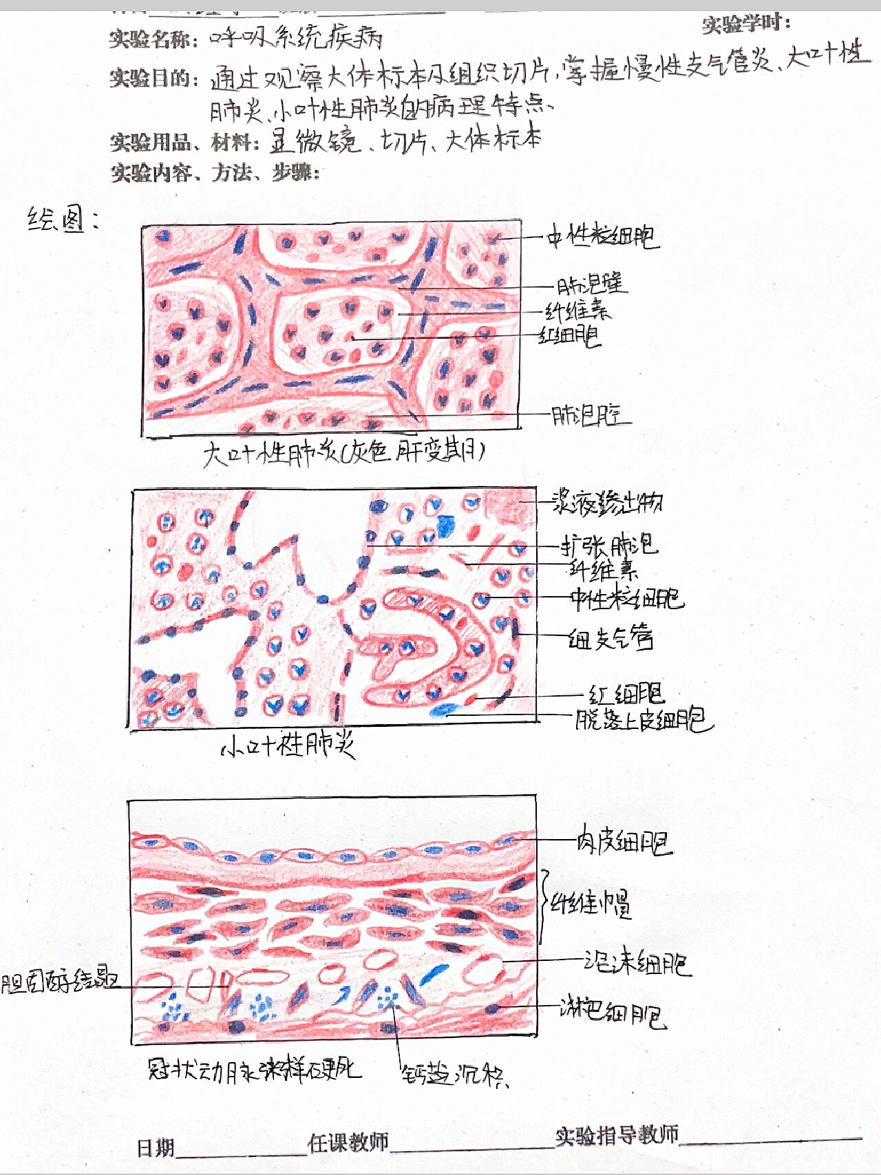 鼻息肉病理手绘图图片