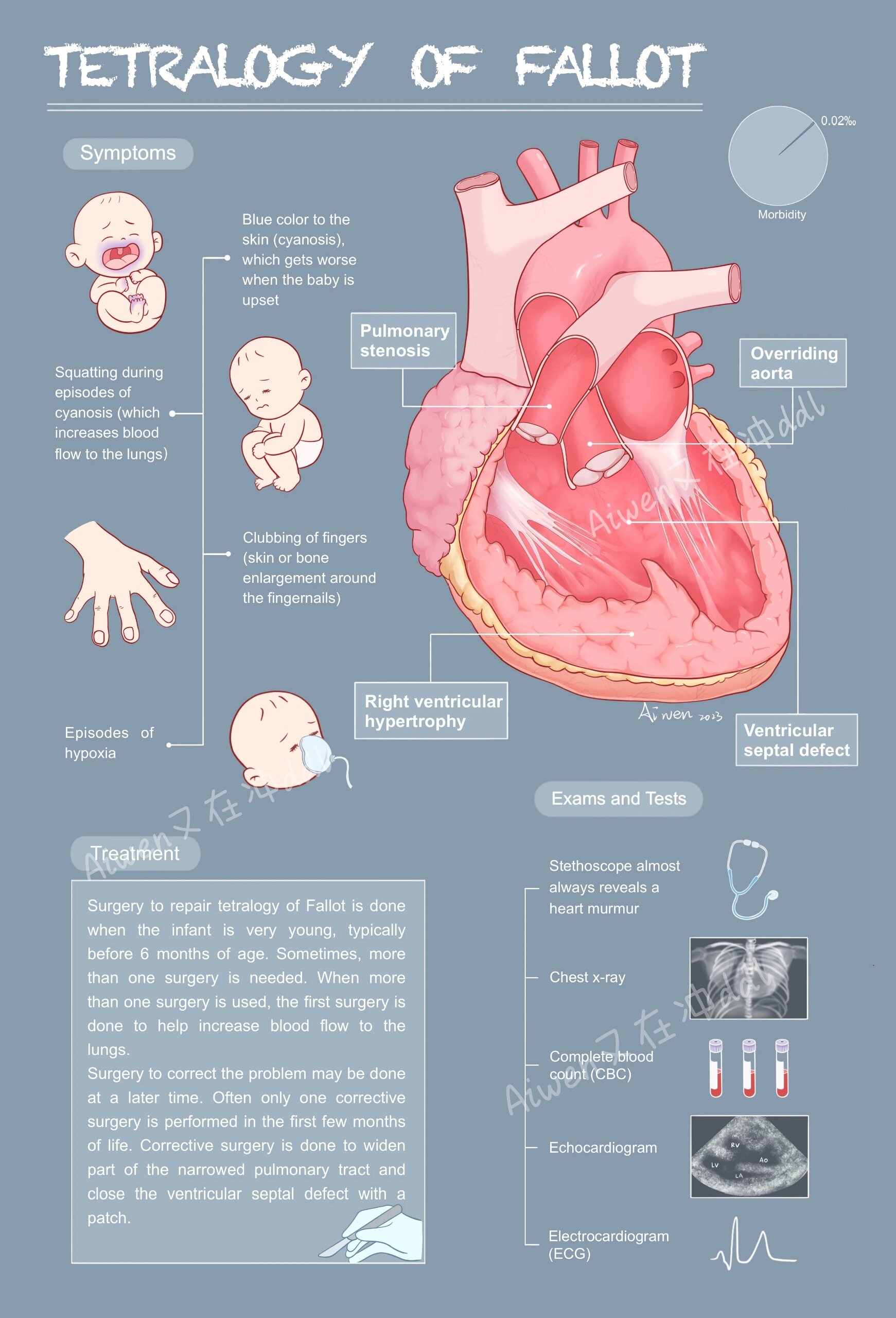 法洛四联症tetralogy of fallot