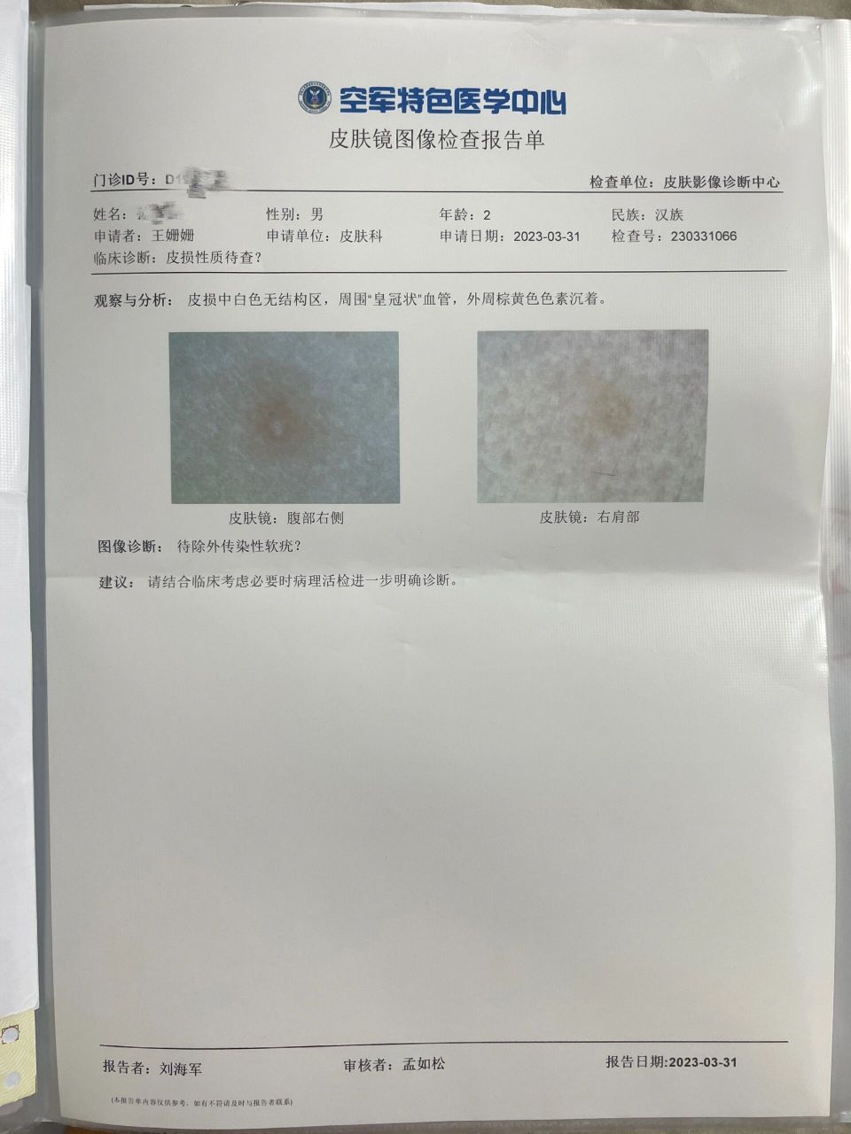 兒童傳染性軟疣 孩子自去年下半年身上起了小包,當時數量不多,就沒當