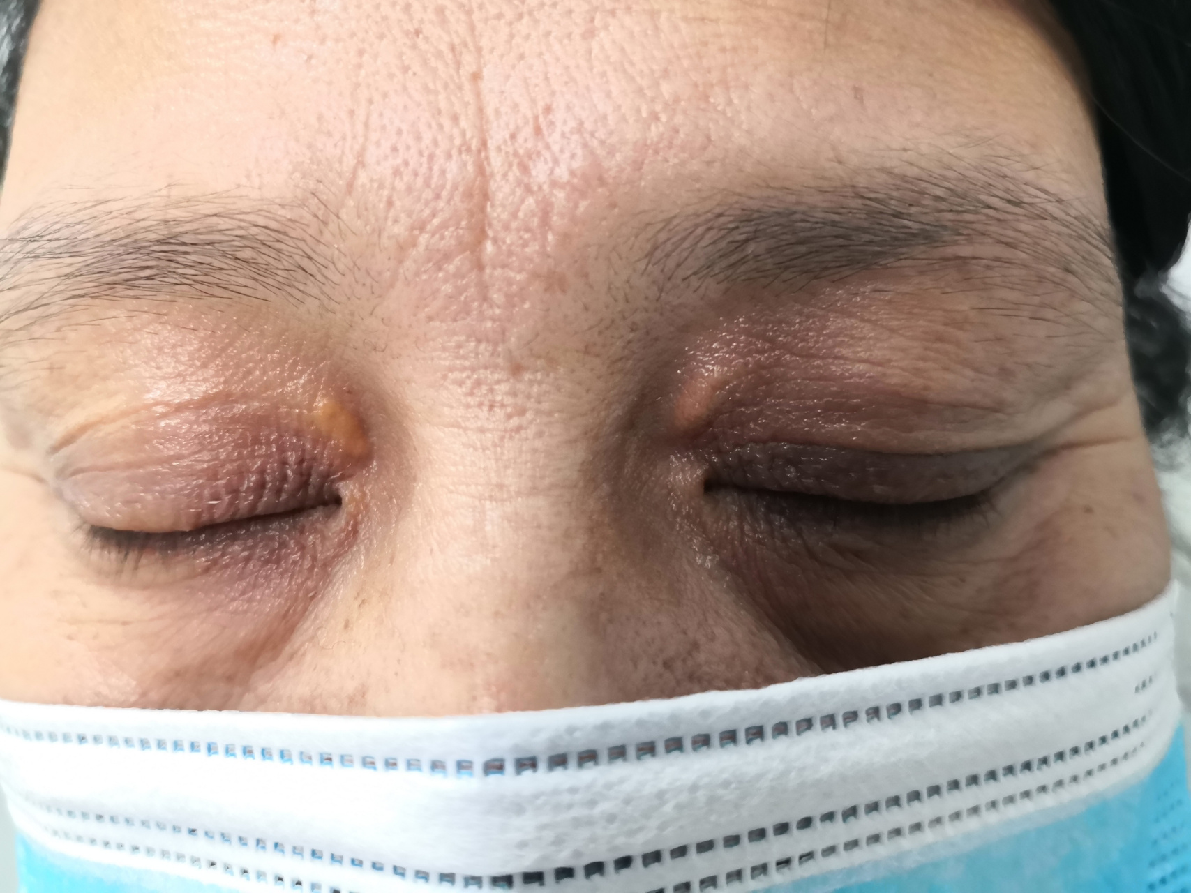 睑黄瘤激光治疗去除前后即刻图片.#美容##激光