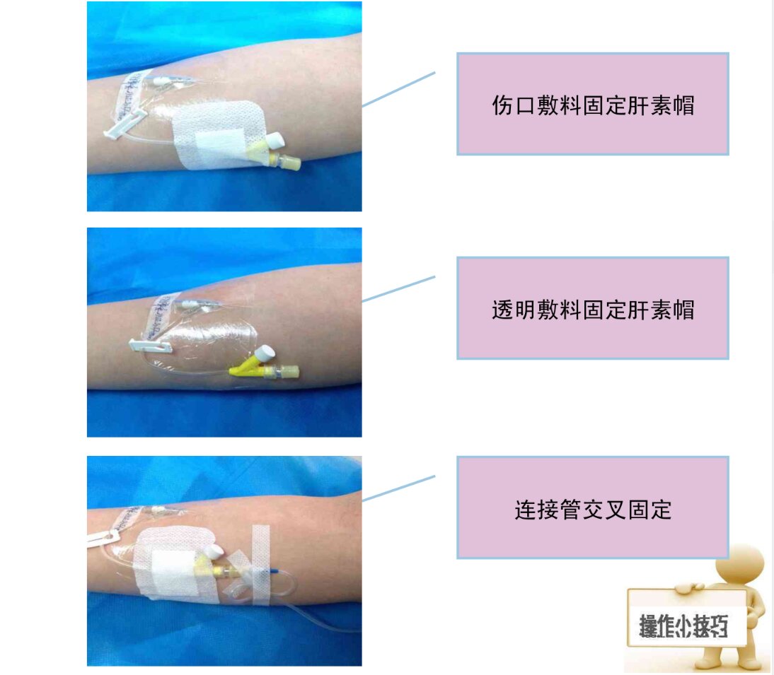 留置针宣教图片图片