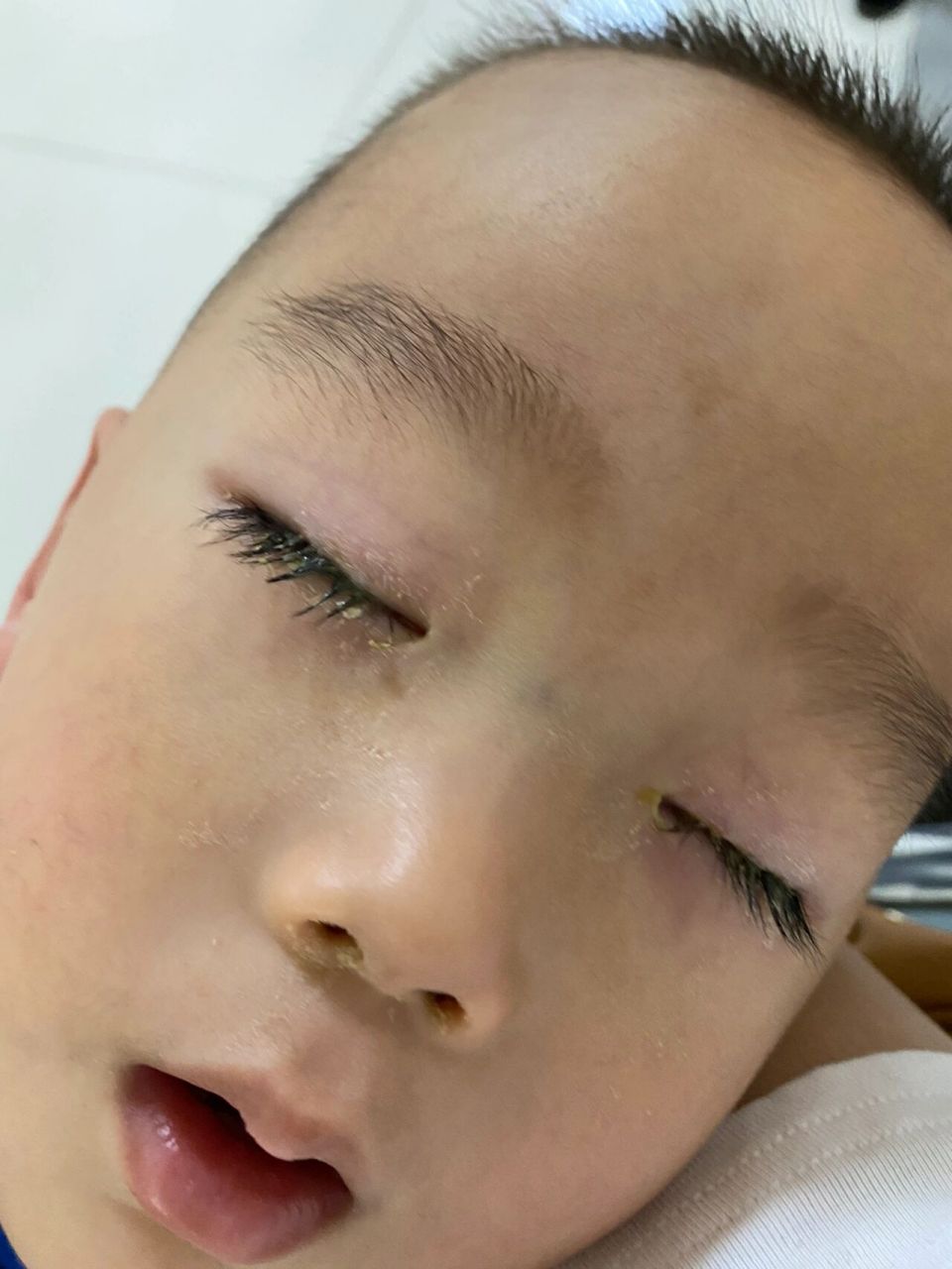 三岁生日当天急性结膜炎 今天是娃三周岁生日,本想着好好庆祝一下