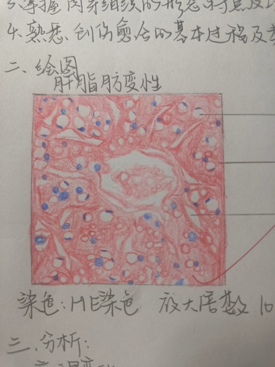 绘制肝硬化镜下红蓝图图片