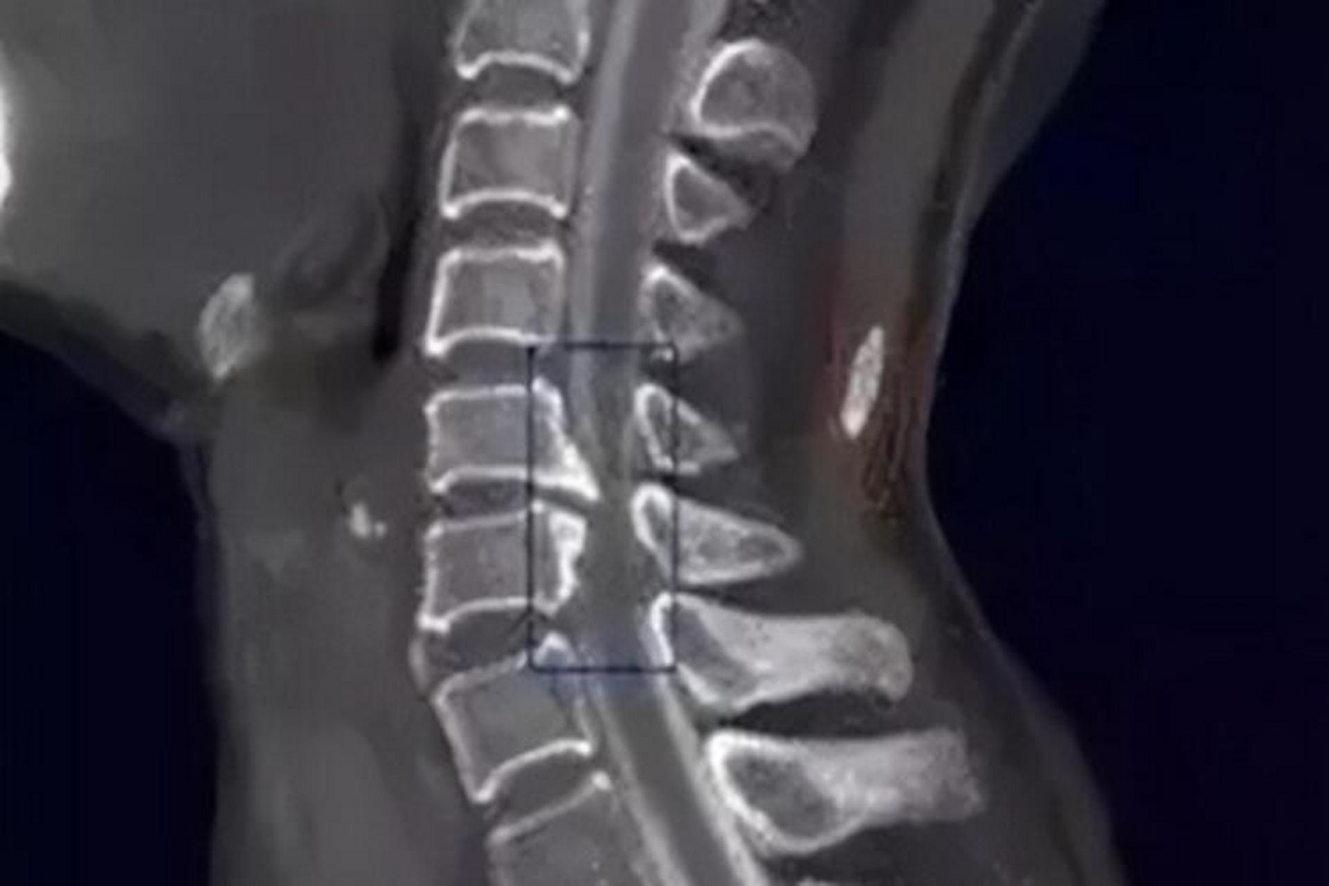 📌颈椎骨质增生表现为颈椎疼痛,活动时有弹响,还可伴有头痛,头晕,手