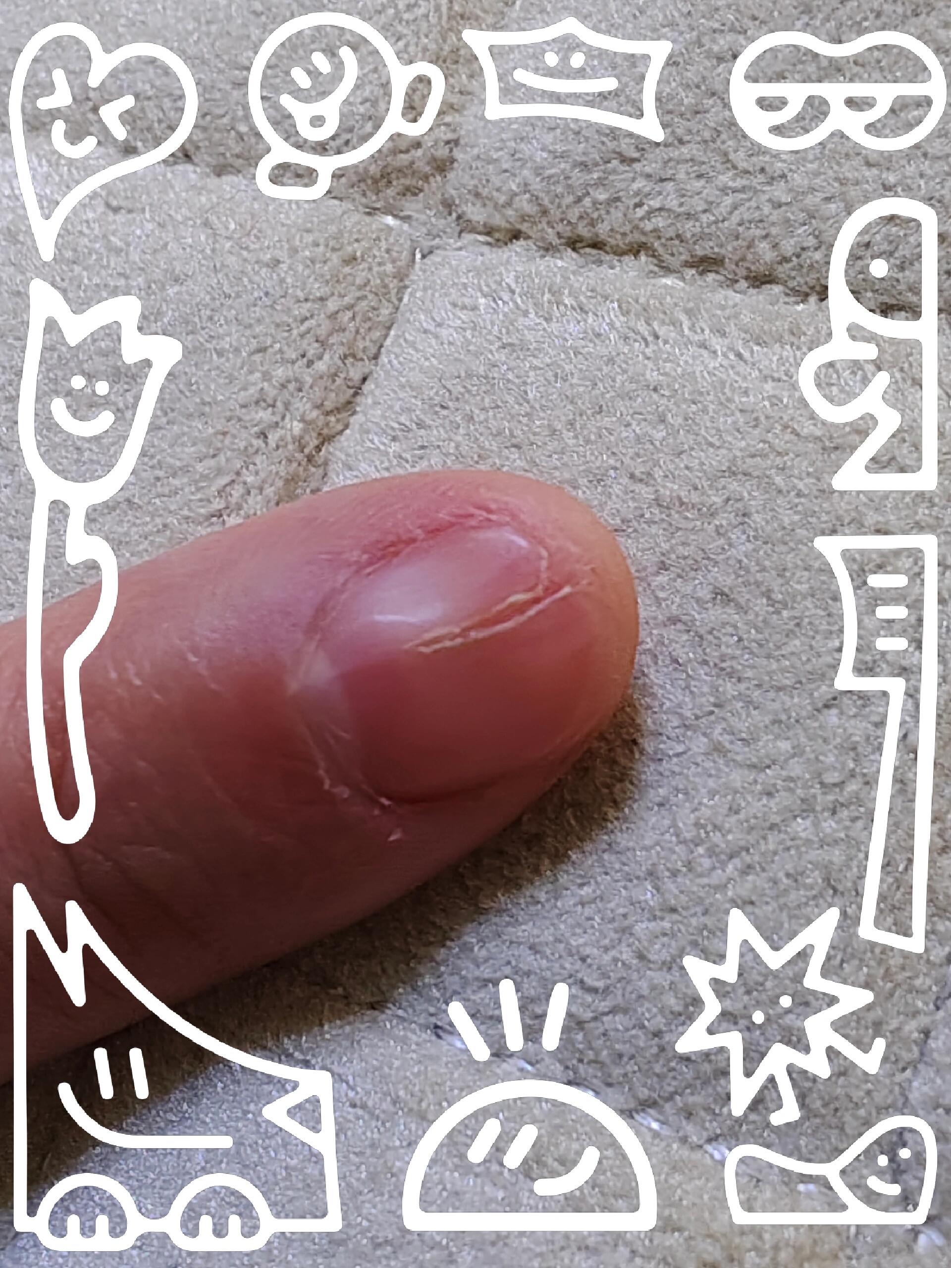 指甲竖着裂开