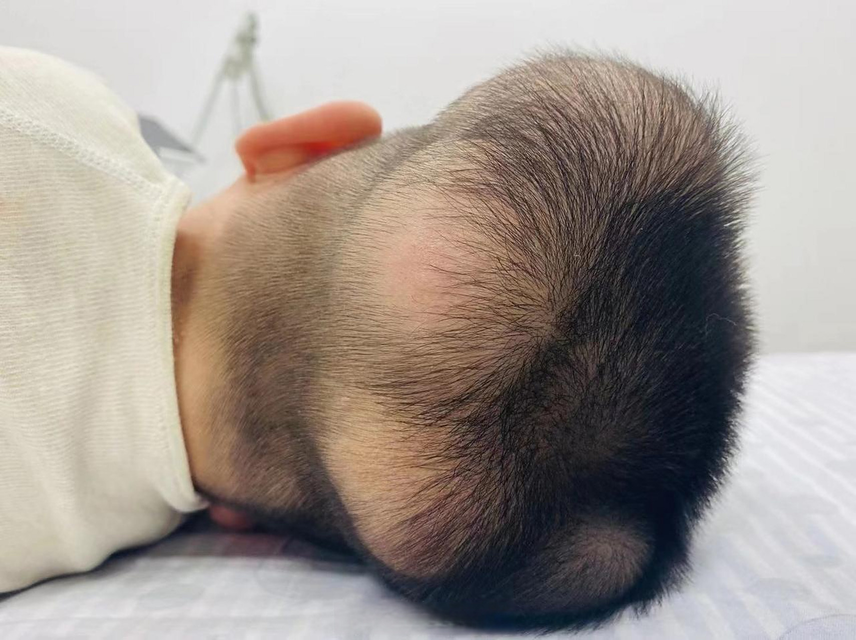 患超级罕见病,国内此前仅报道过1例】男童患超级罕见病头部长满肿瘤