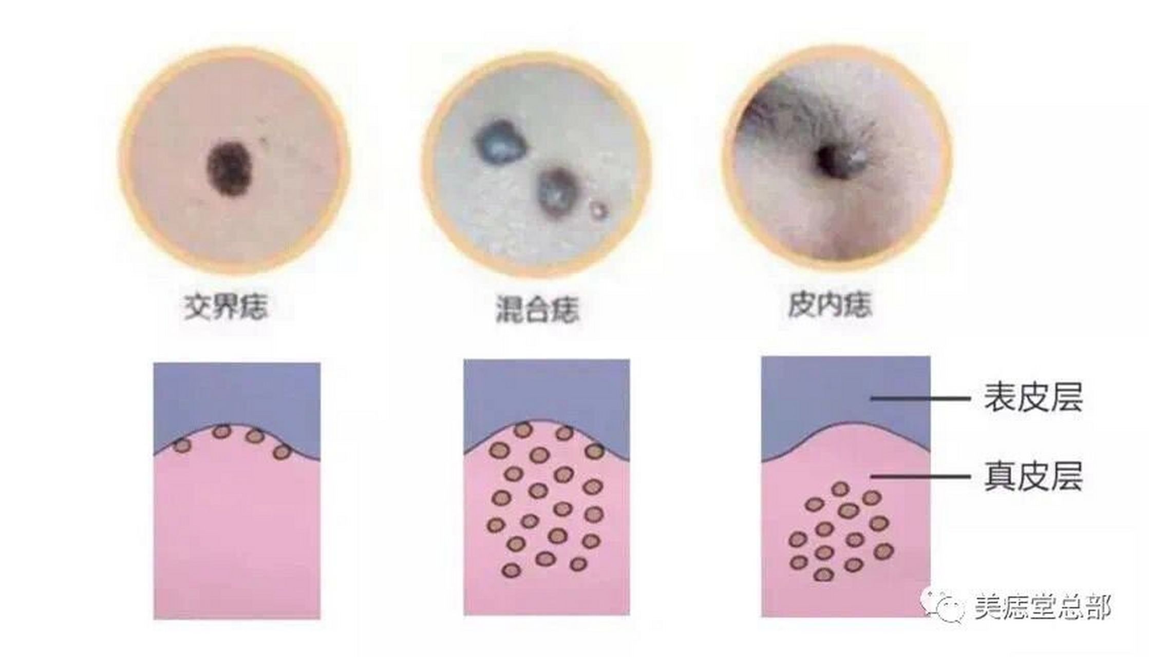 痣的区别图片图片