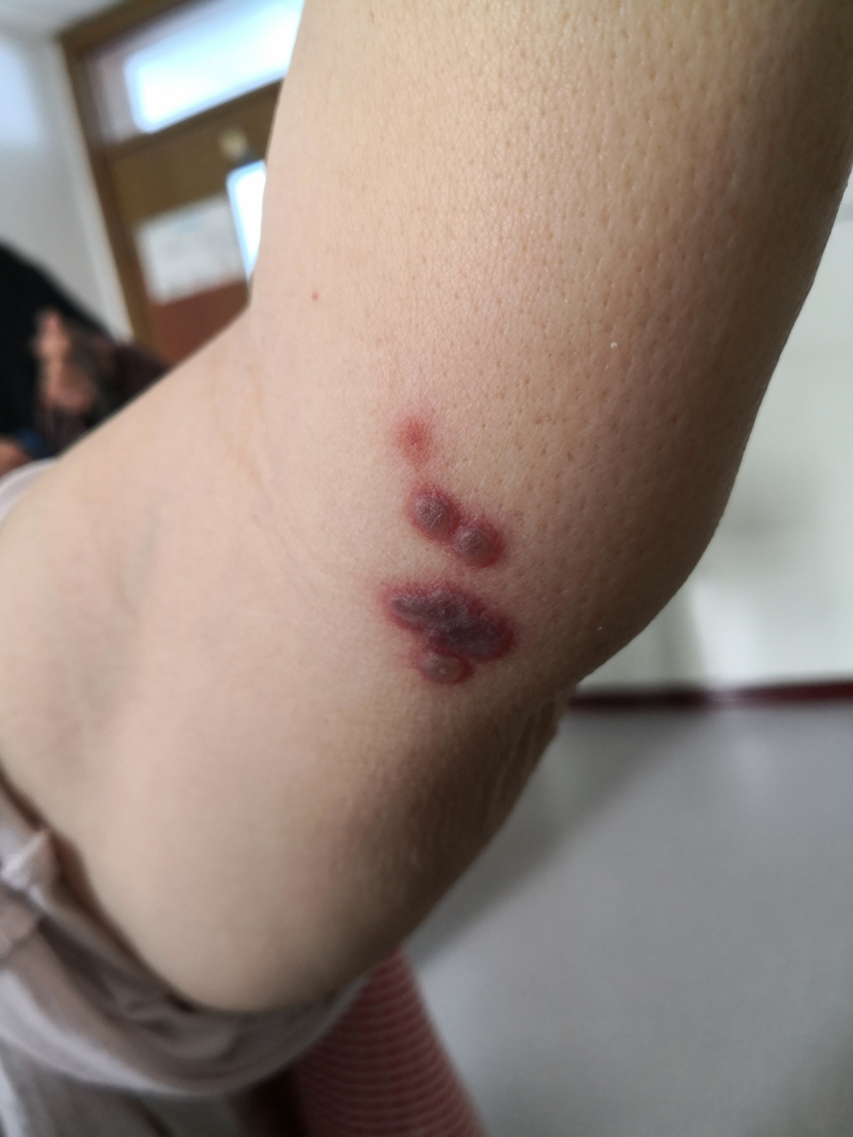 一侧手臂的水疱症状,有手臂疼痛症状.考虑带状疱疹早期症状.