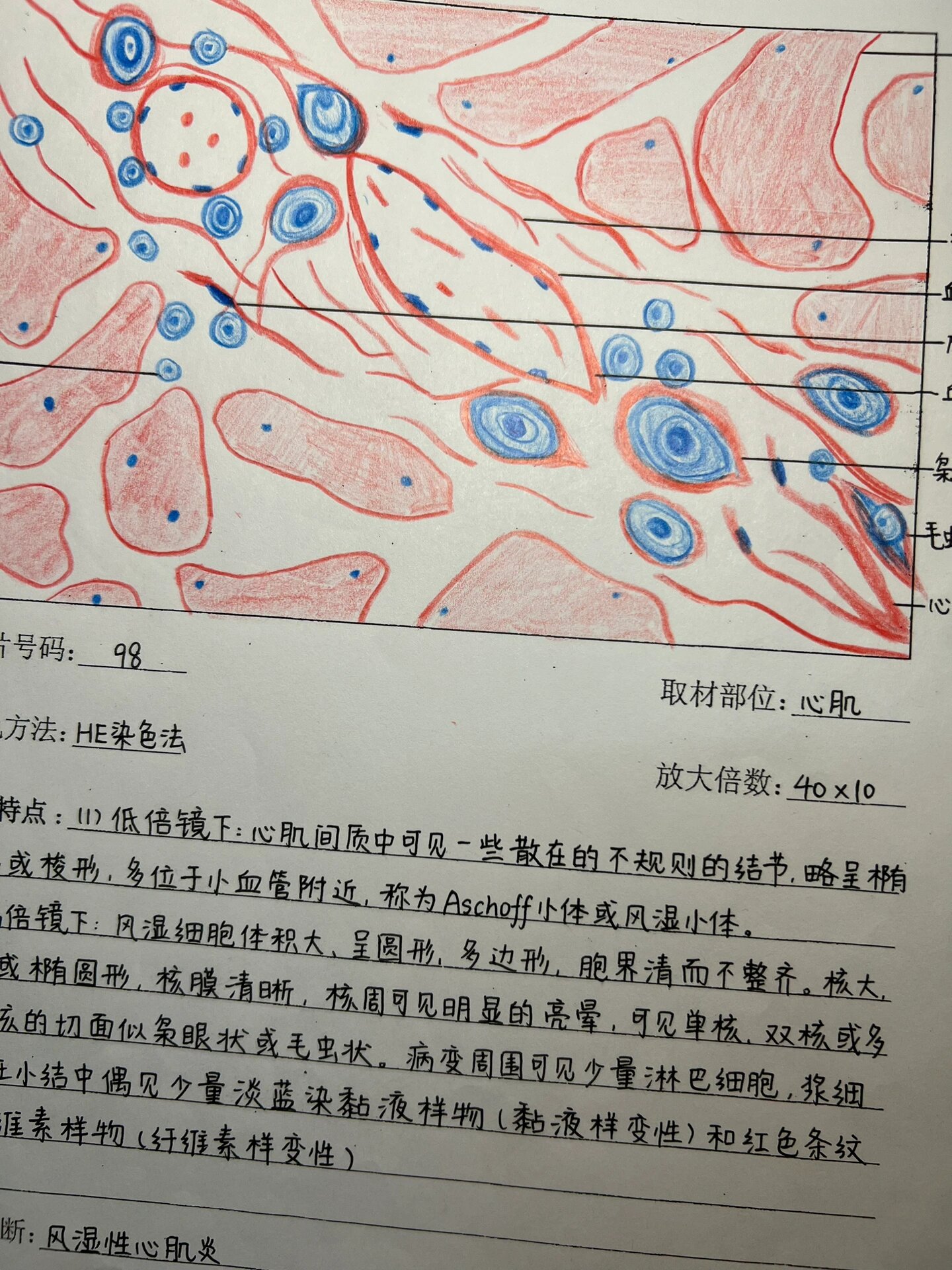 风湿性心肌炎病理图片