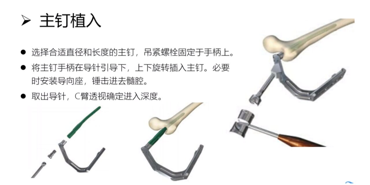 股骨髓内钉(pfna)手术步骤