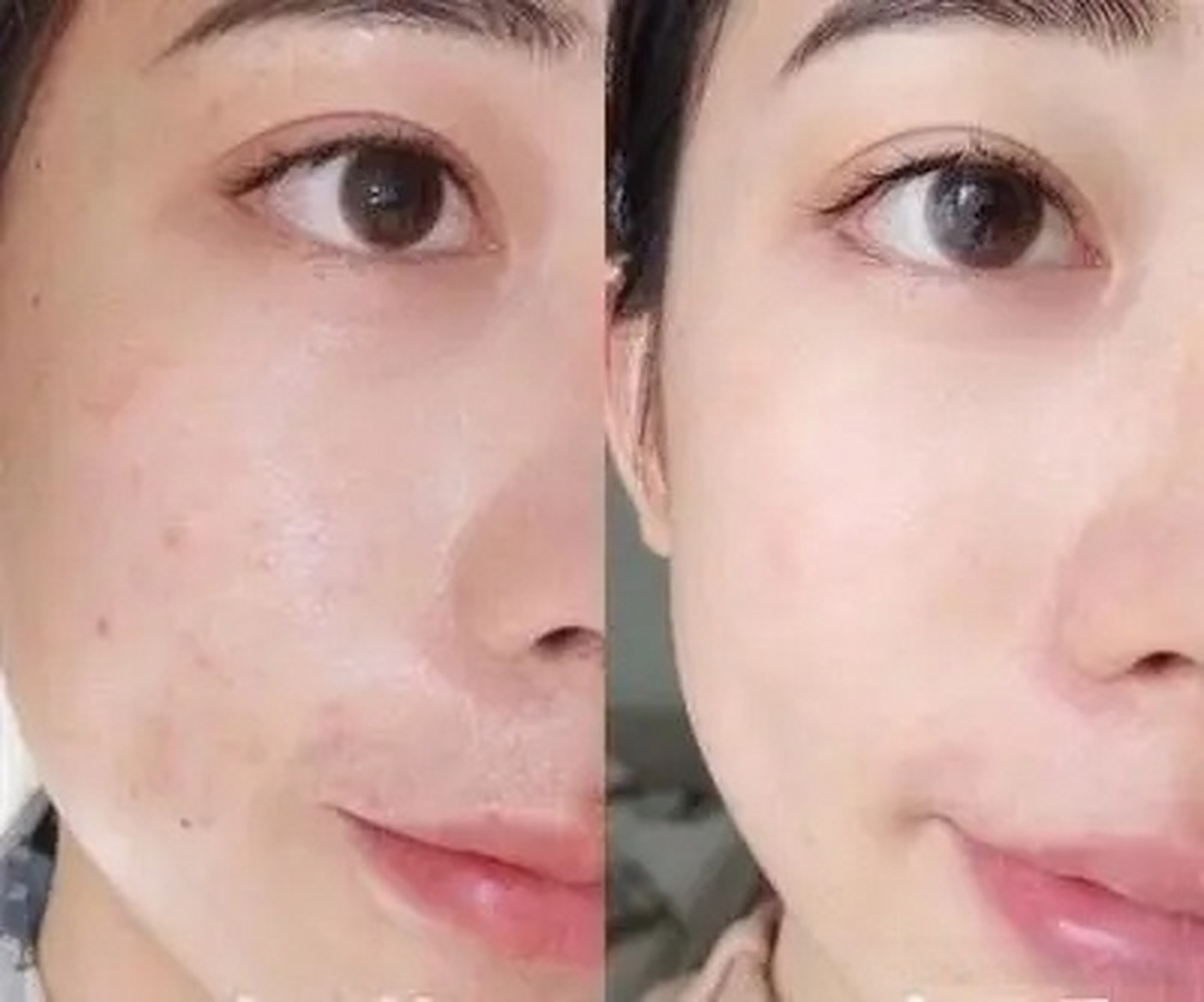 超皮秒祛斑要做几次才能去除干净?美白祛斑霜哪个牌子效果较好?