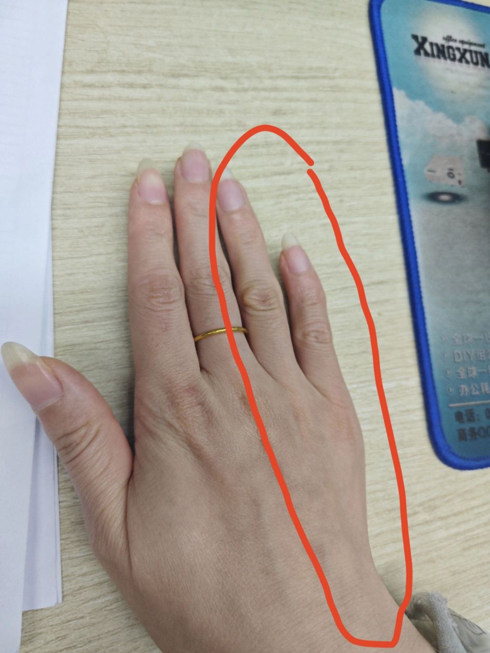 小拇指和无名指麻木 什么原因?