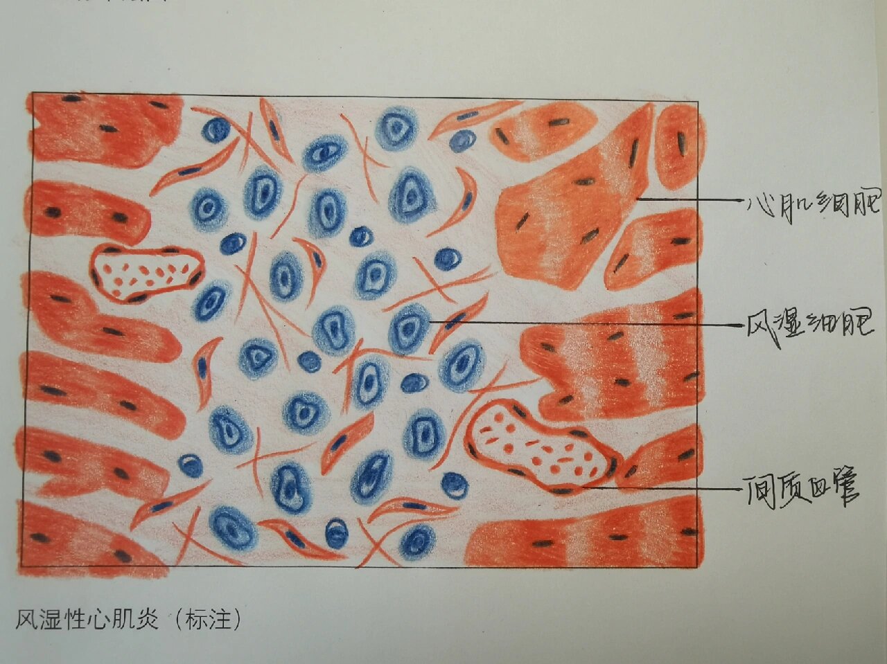 病理实验报告 风湿性心肌炎绘图