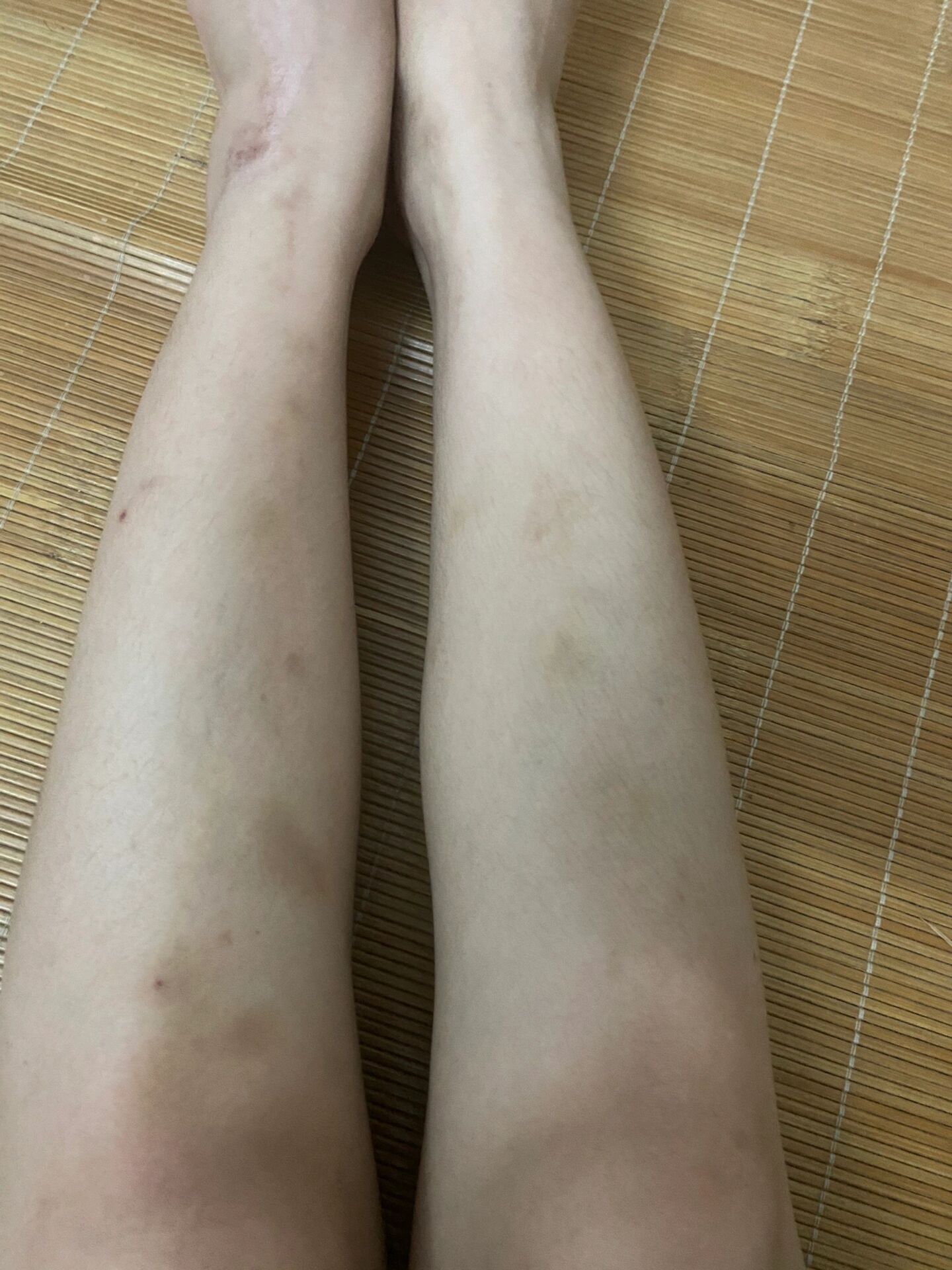 我青一块紫一块的小腿,不晓得碰哪了