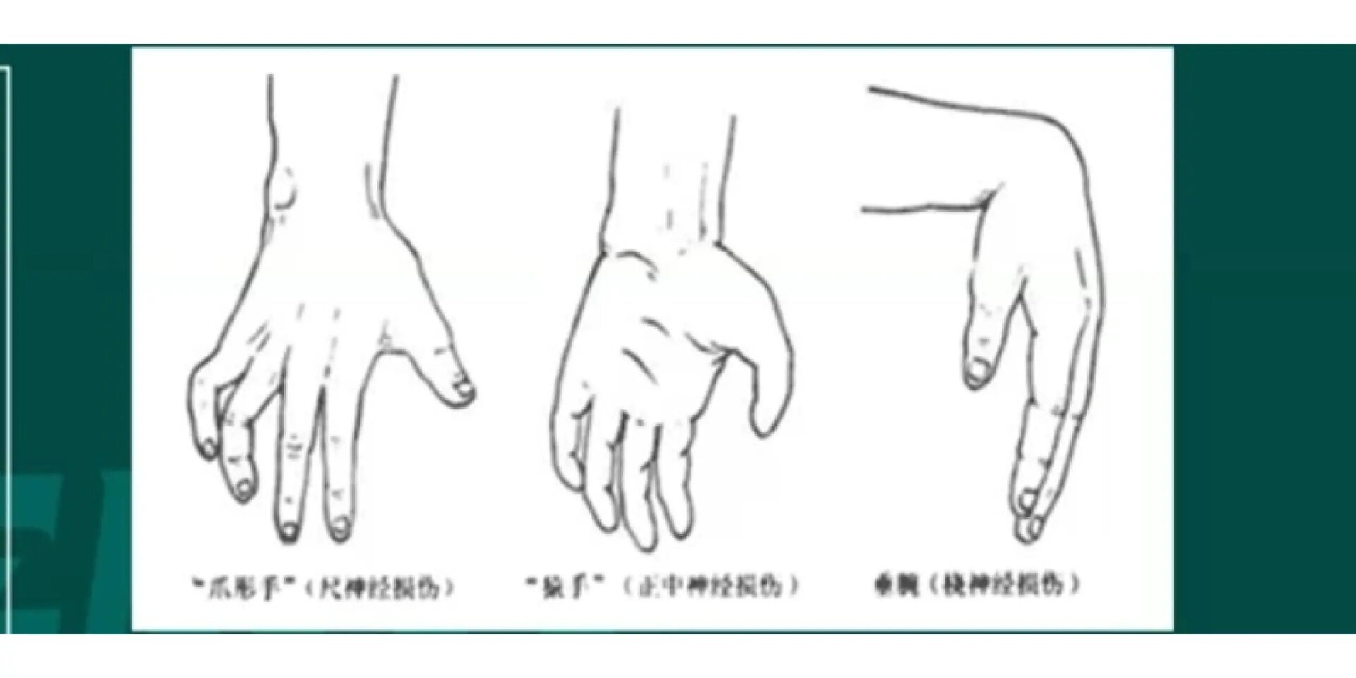 尺神经损伤→爪形手 正中神经损伤→猿形手 桡神经损伤→垂腕