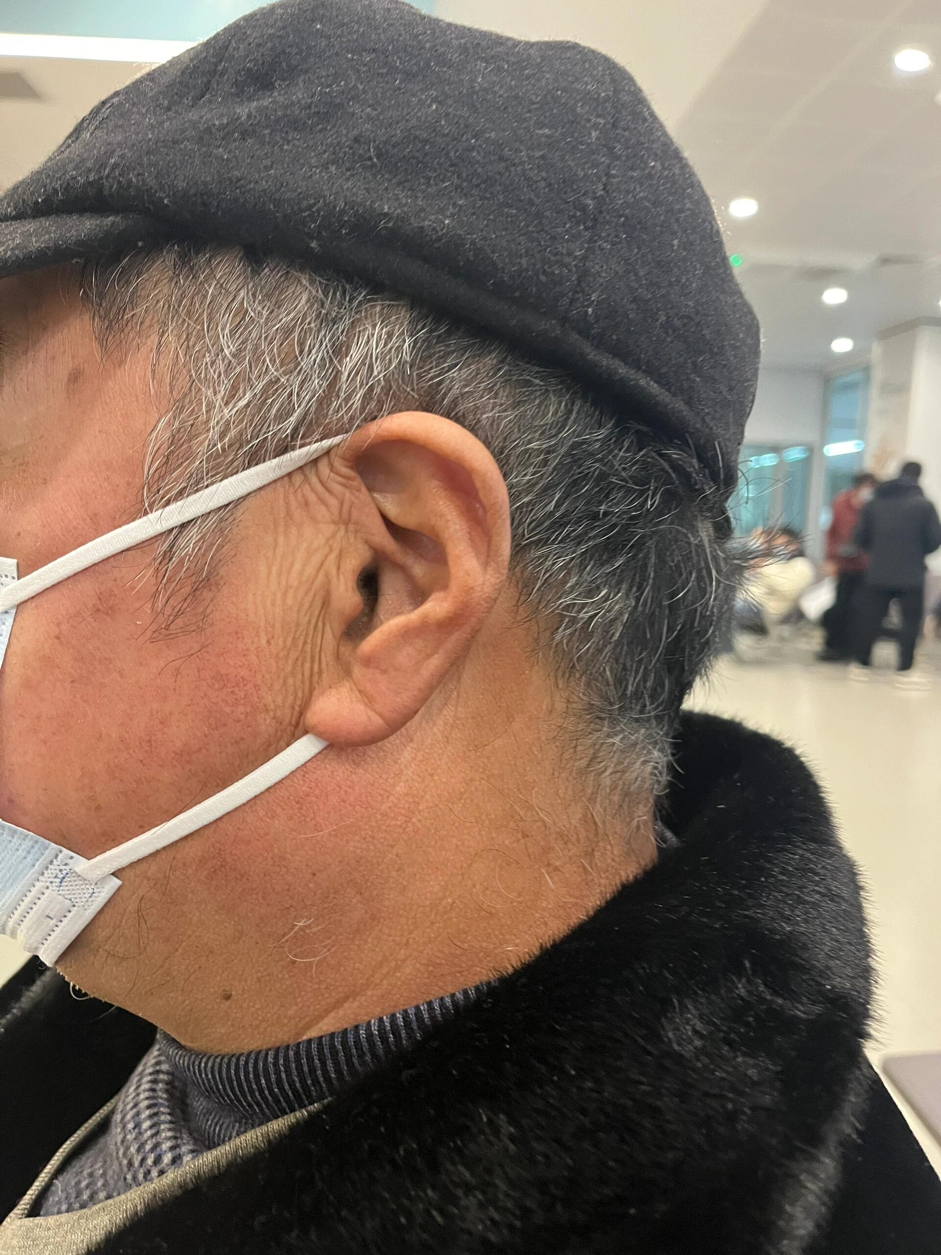 爸爸耳朵这边的褶皱是什么生病的征兆吗?